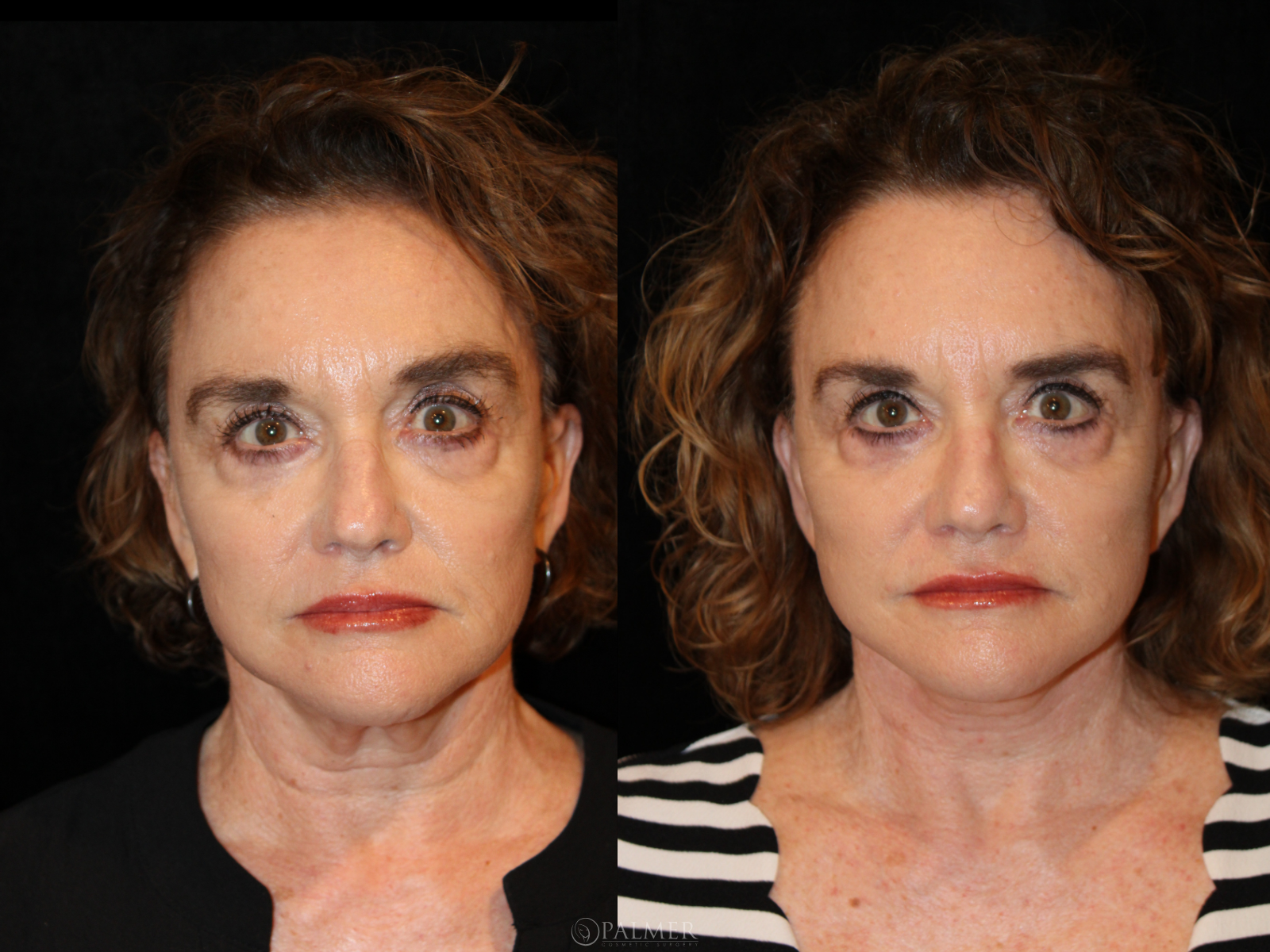 facelift before and after front View