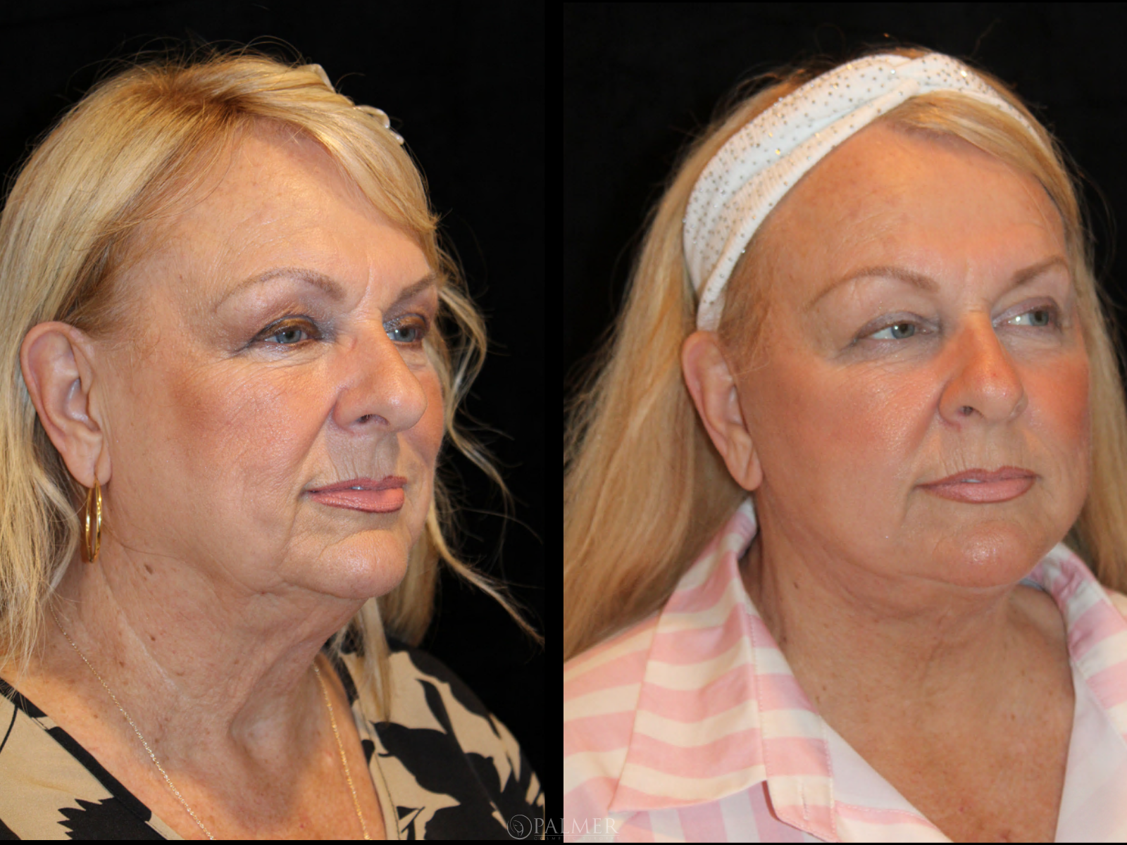 Facelift before and after side View