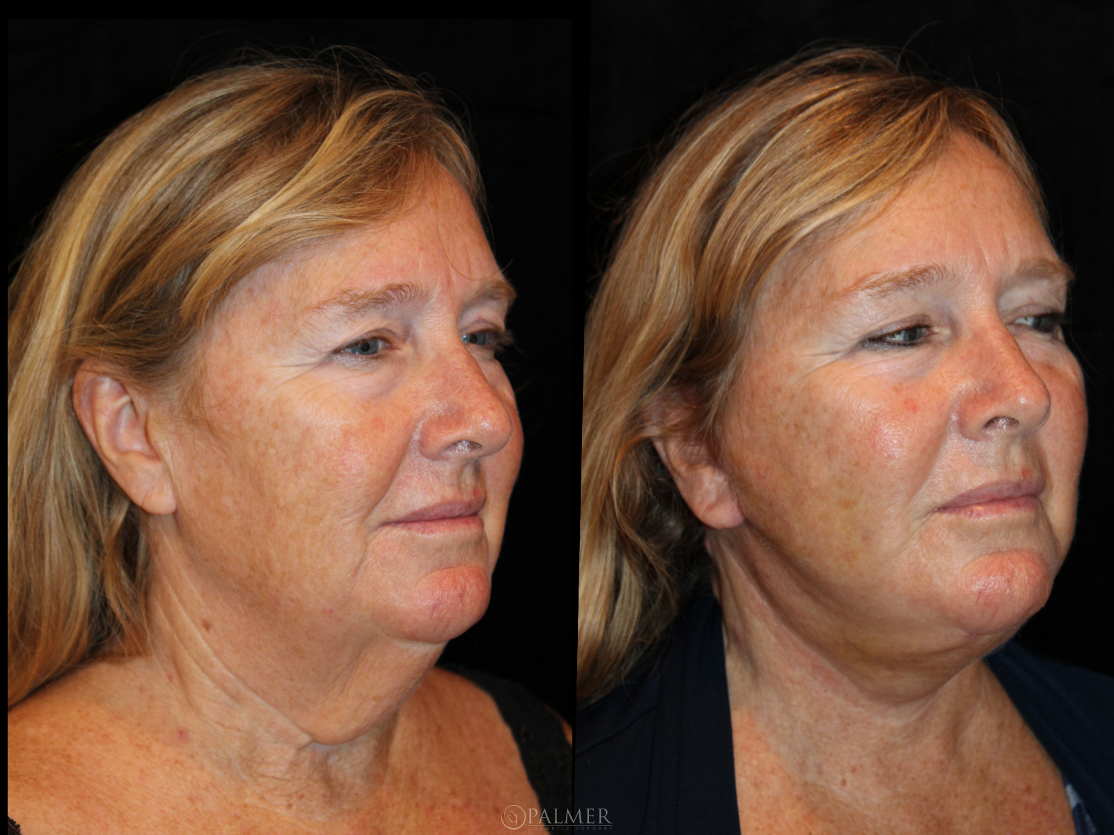 Facelift before and after  side View