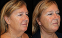 Facelift before and after  side View