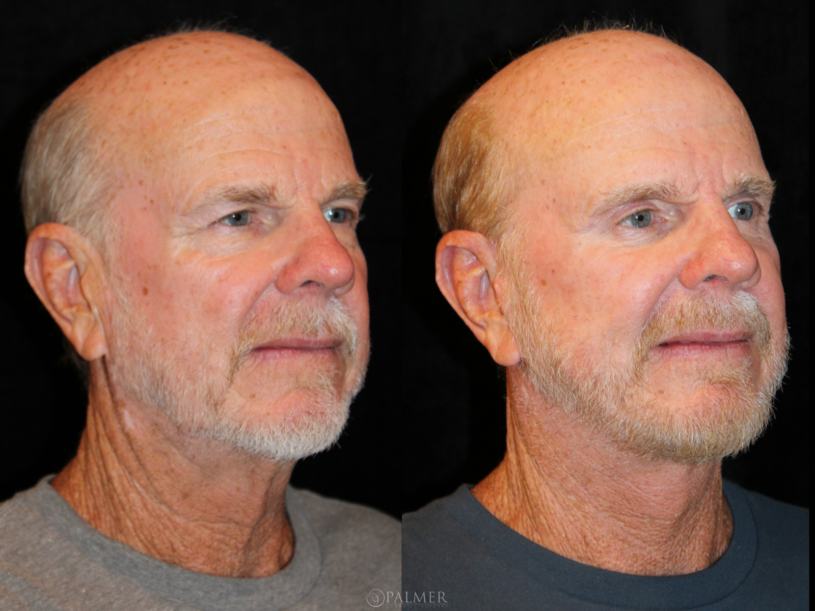 Facelift before and after SIDE VIEW