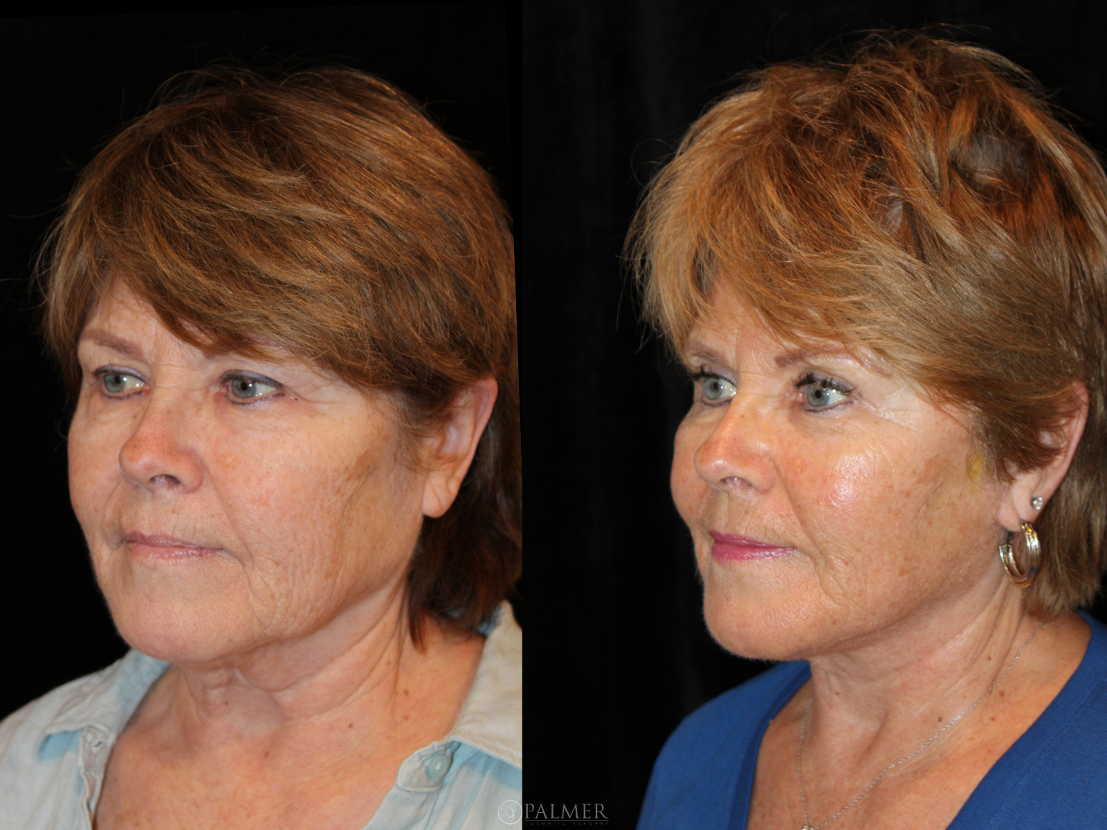 facelift before and after Side View