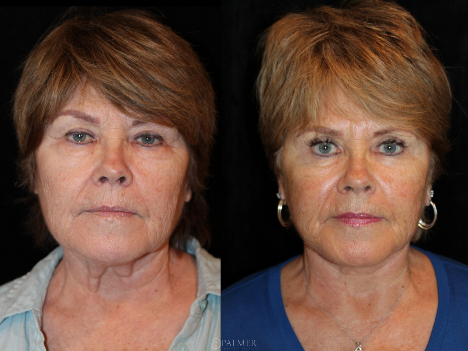 Facelift before and after  Front View