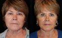 Facelift before and after  Front View