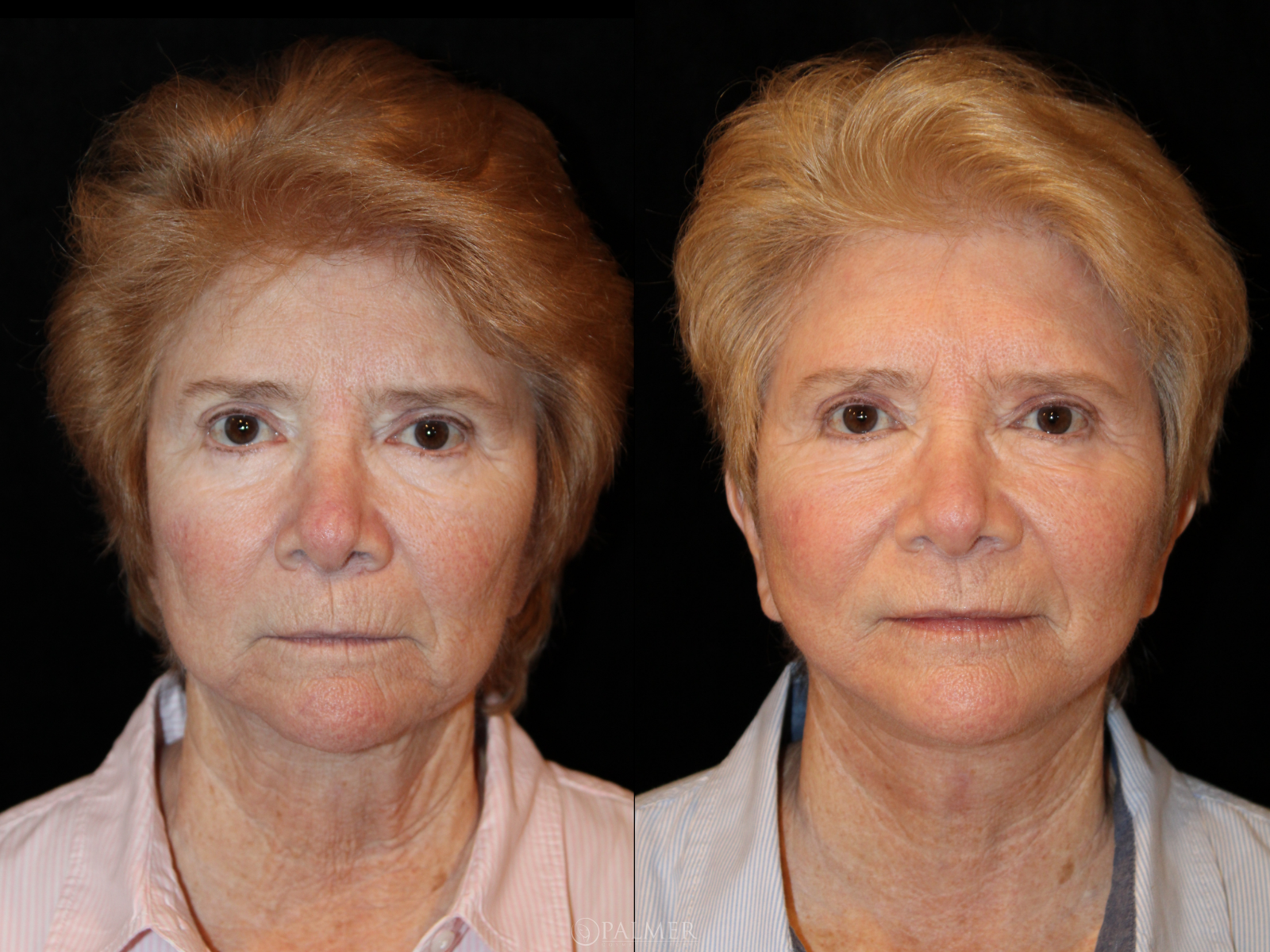 facelift before and after Side View