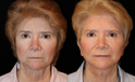facelift before and after Side View