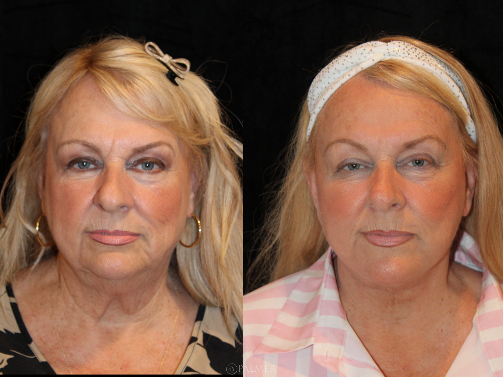 Facelift before and after  Front View