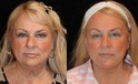 Facelift before and after  Front View