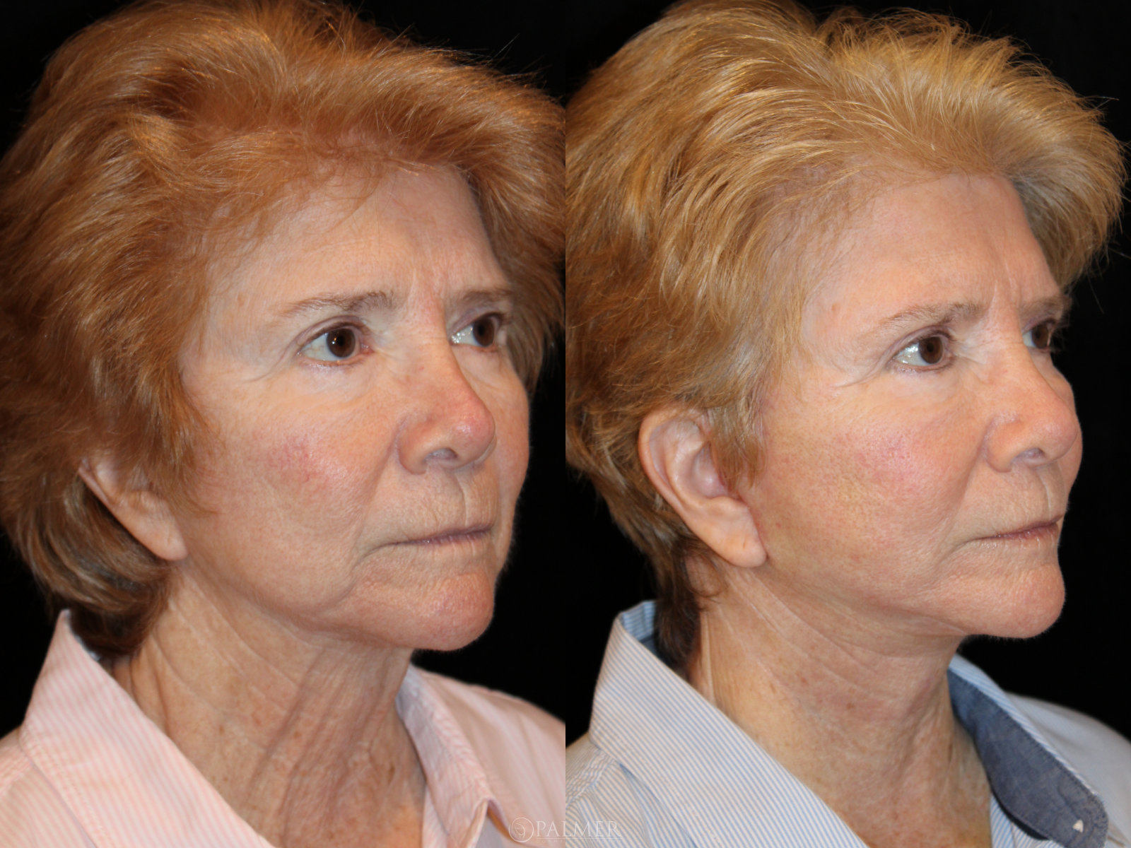 facelift before and after Side View