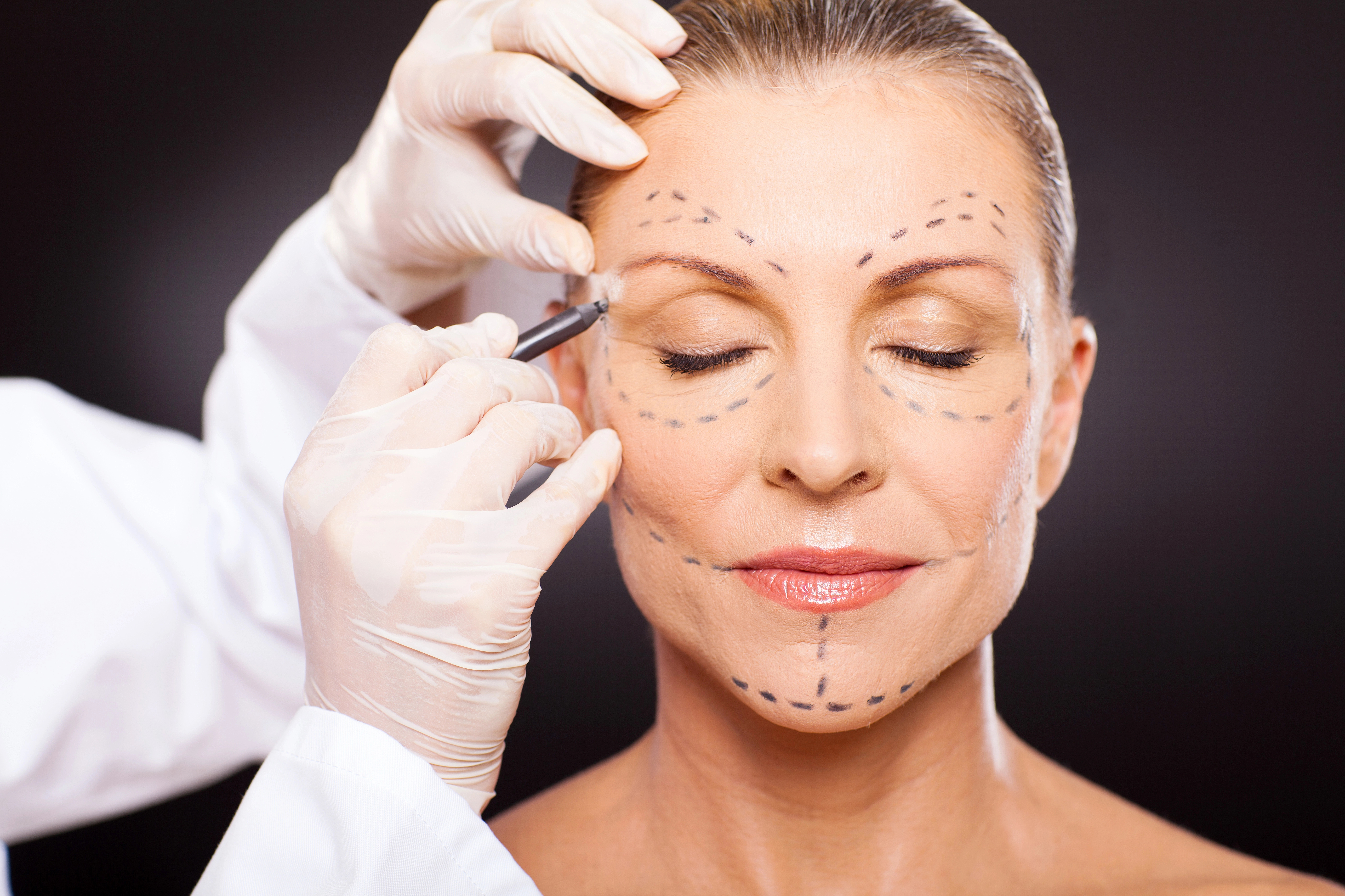 A woman with closed eyes and facial markings prepares for cosmetic surgery. A gloved hand holds a marker near her face.