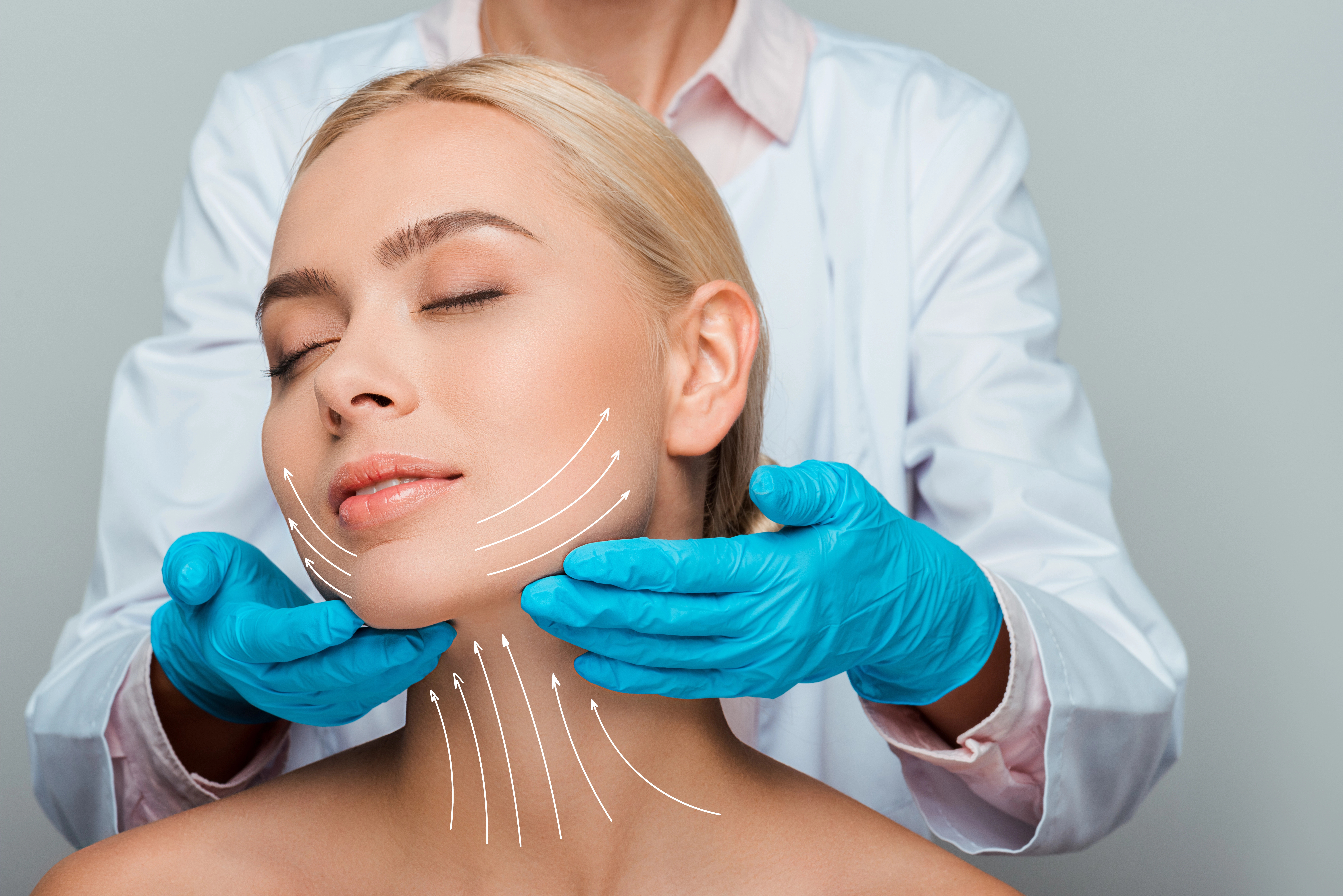 woman with surgical marking indicating face lift direction