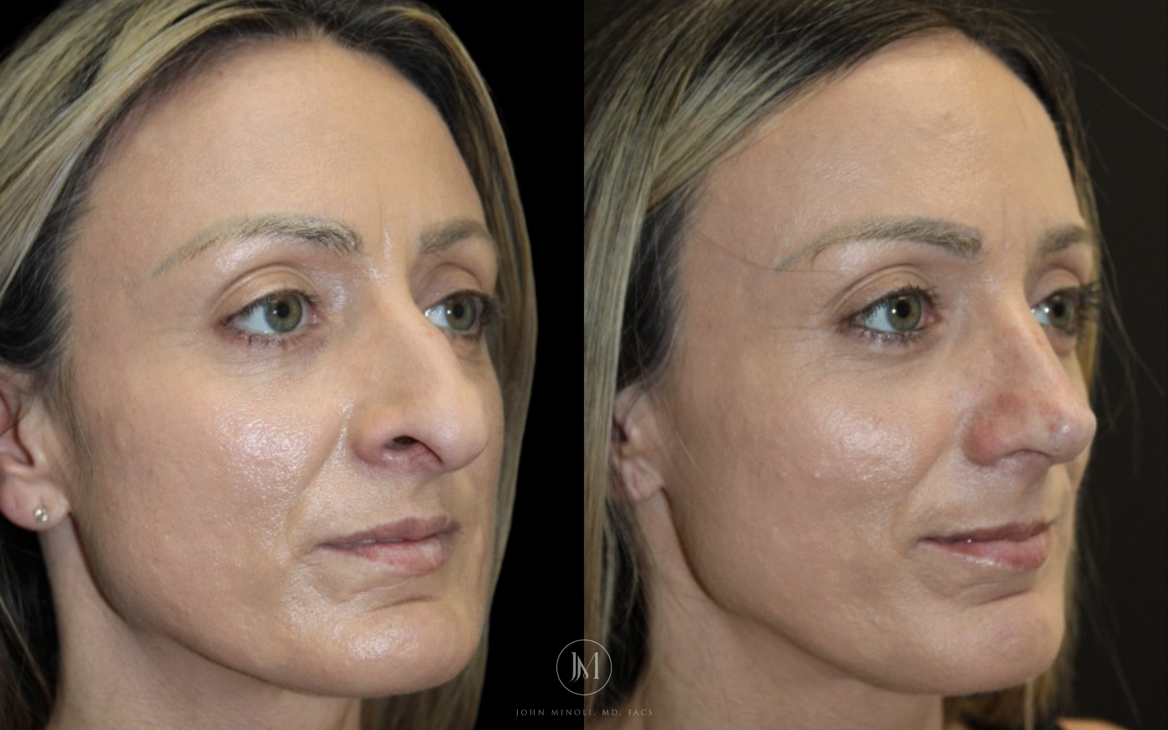 Primary Rhinoplasty before and after