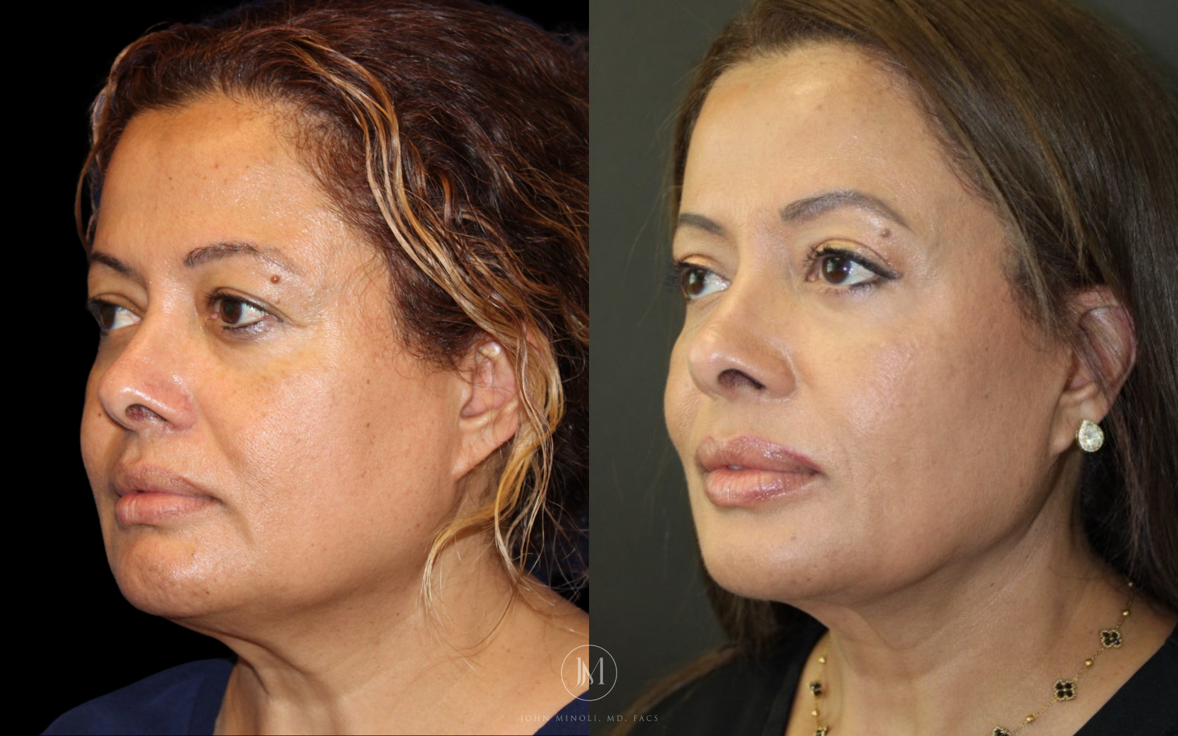 Face and Neck Lift Before and After