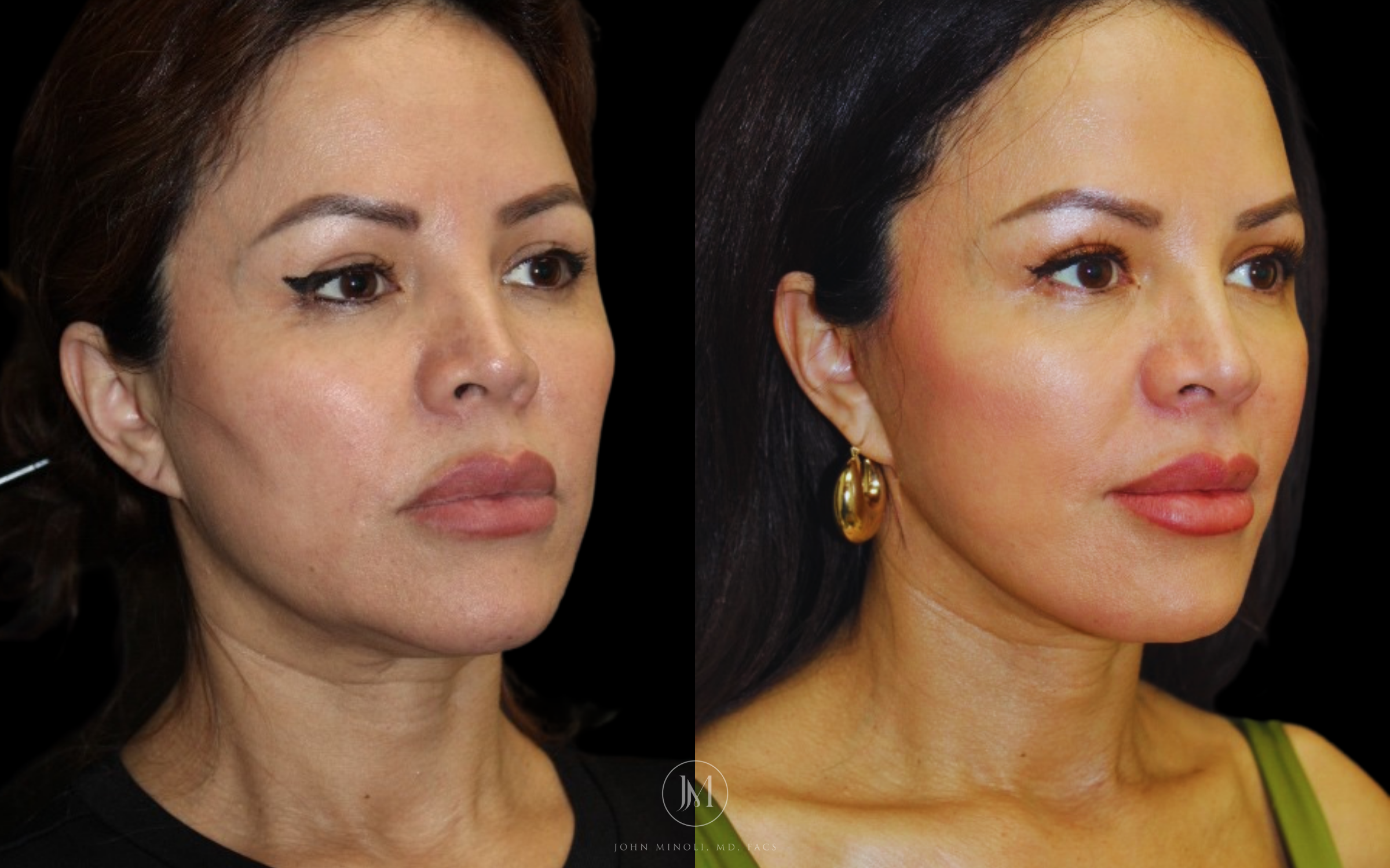 Neck Lift Before and After