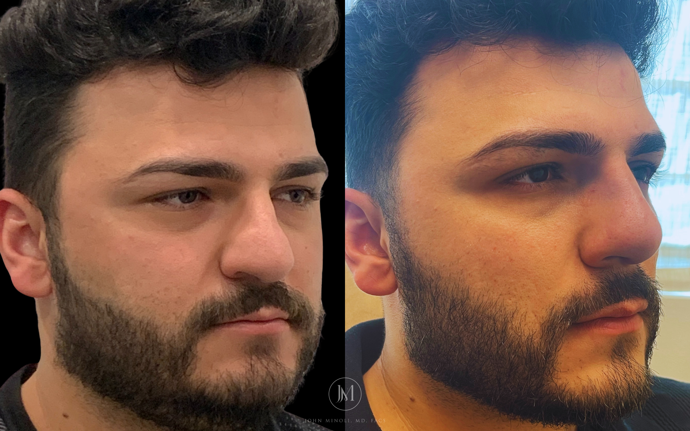 Primary Rhinoplasty before and after
