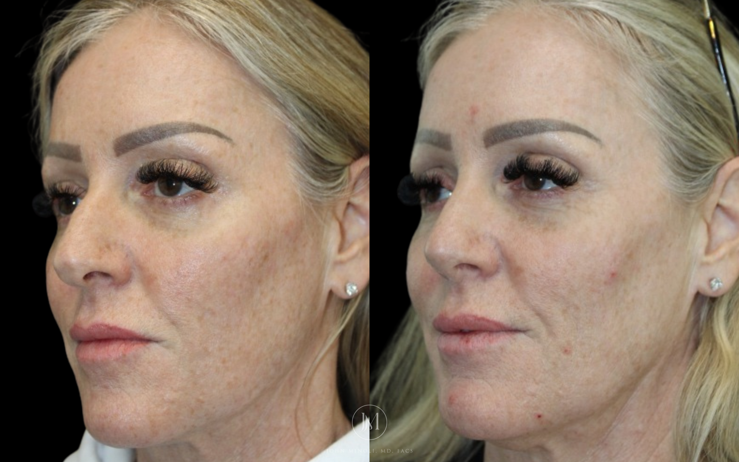 Woman Primary Rhinoplasty B&A LEFT