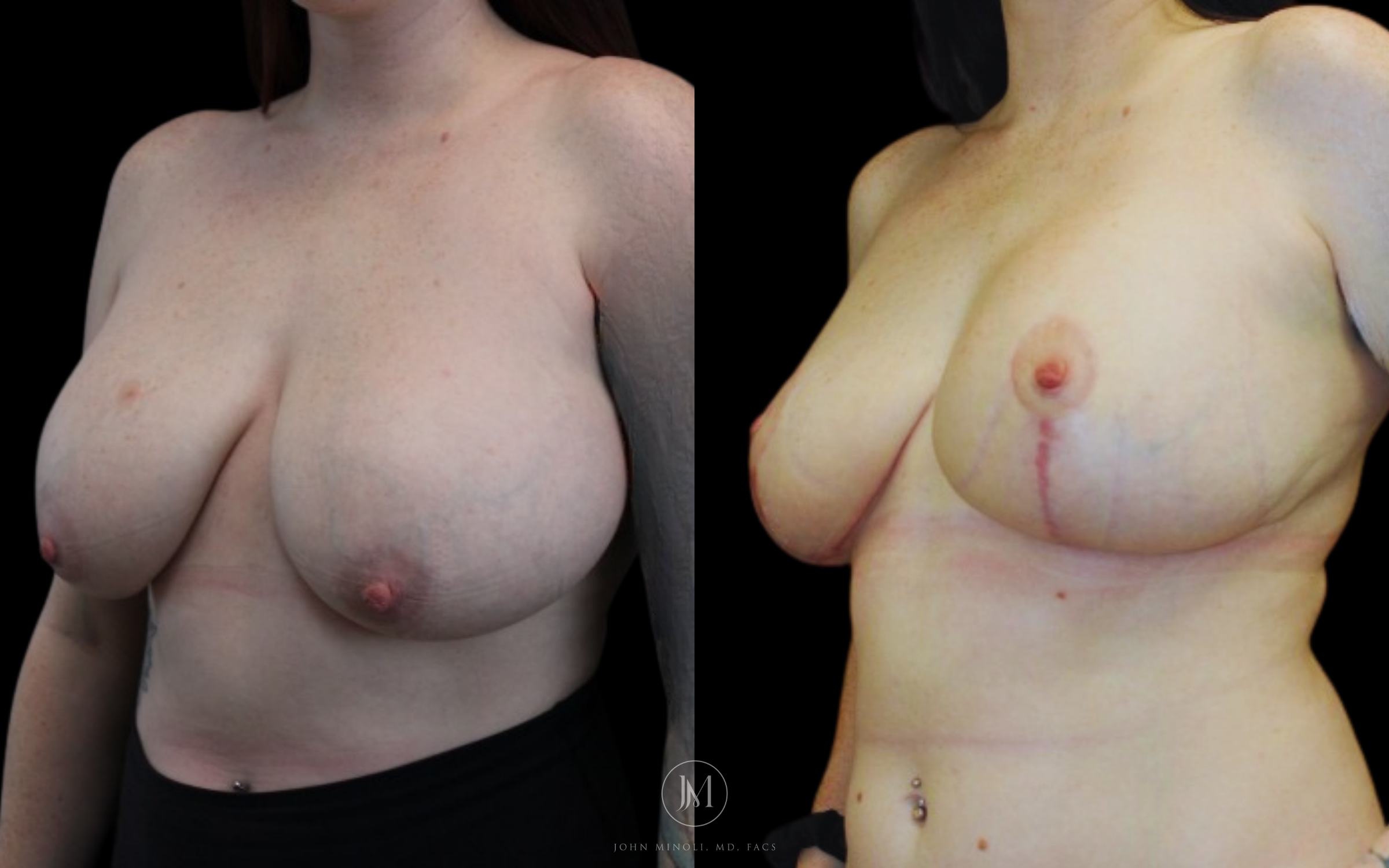WOMAN BREAST RECONSTRUCTION  B&A