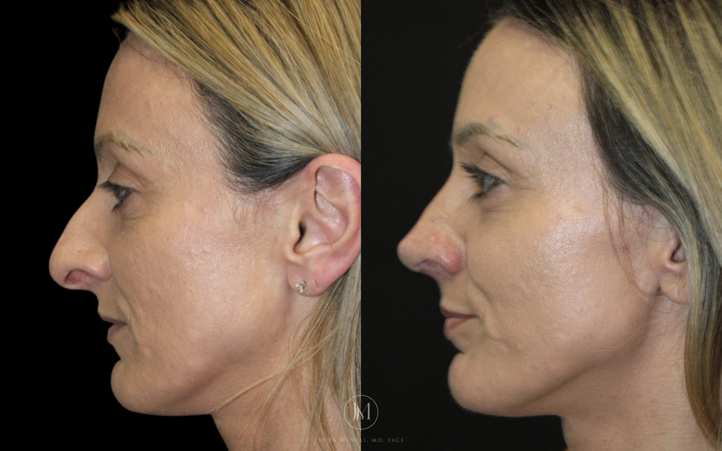 Primary Rhinoplasty before and after