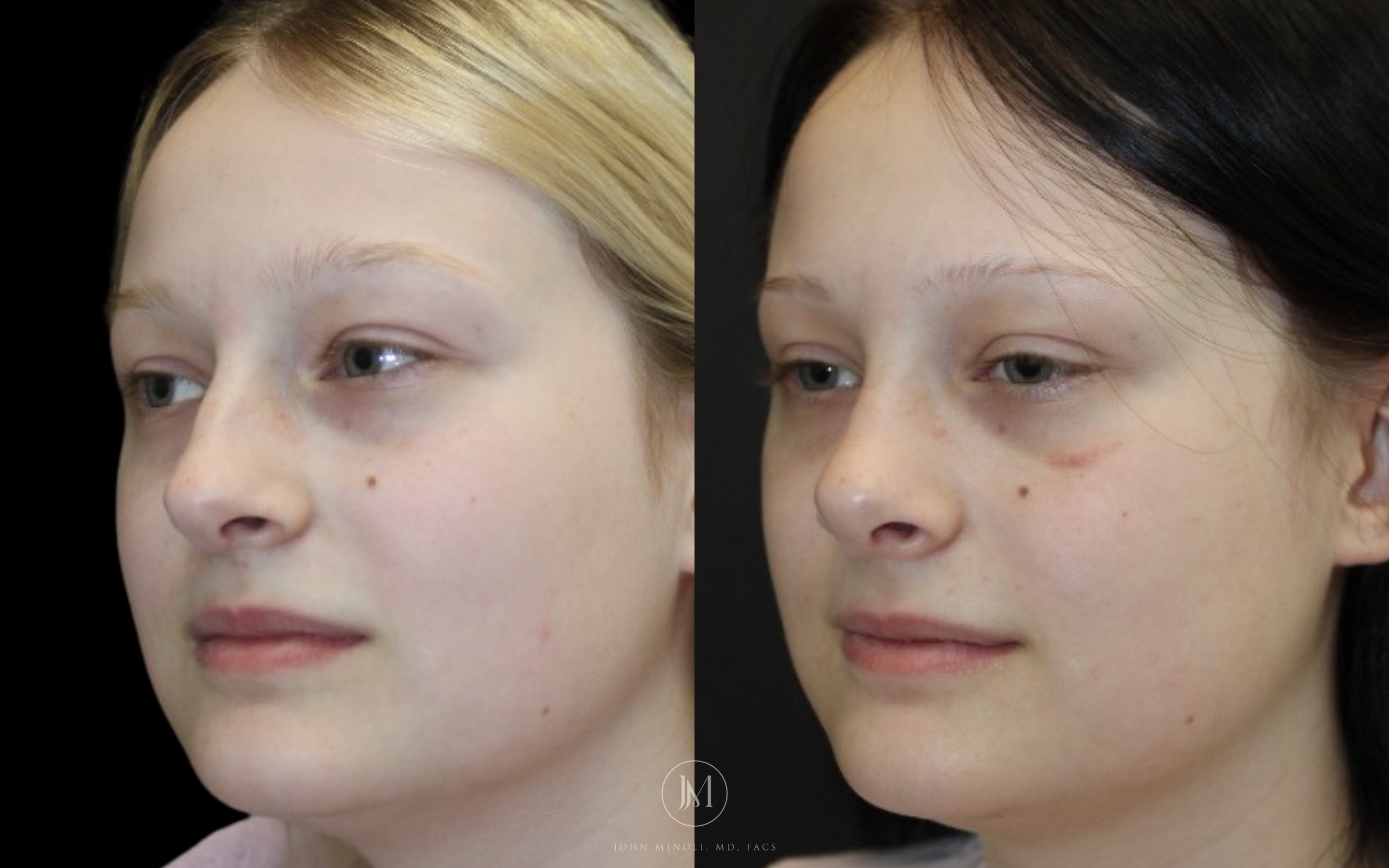 Primary Rhinoplasty before and after