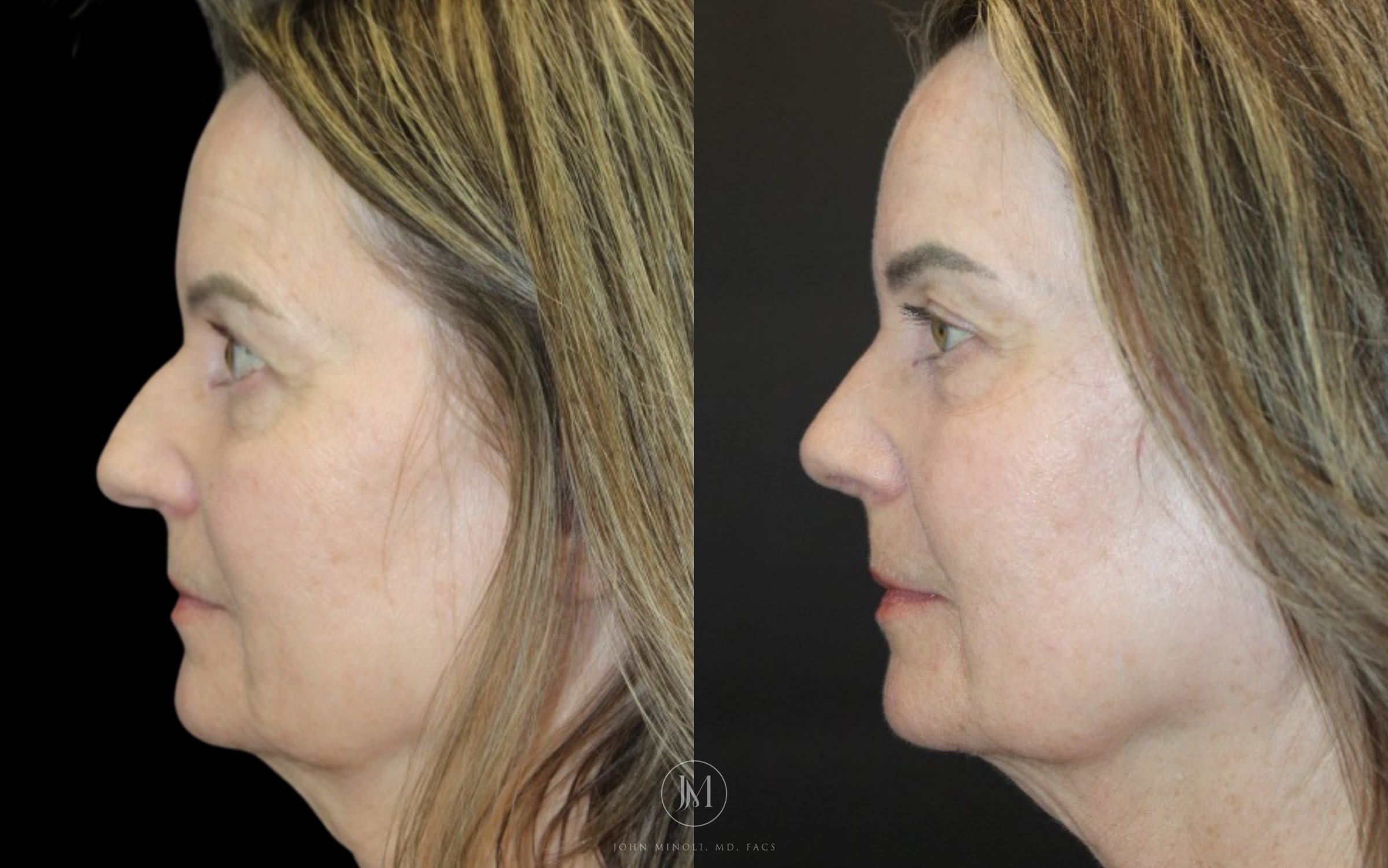 Primary Rhinoplasty before and after