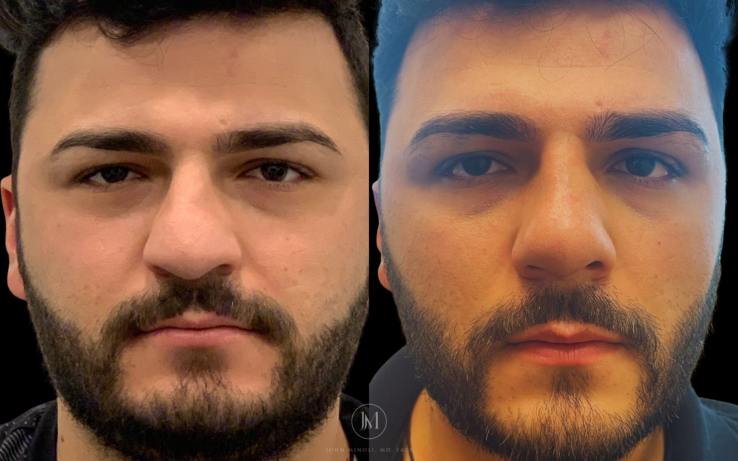 Primary Rhinoplasty before and after