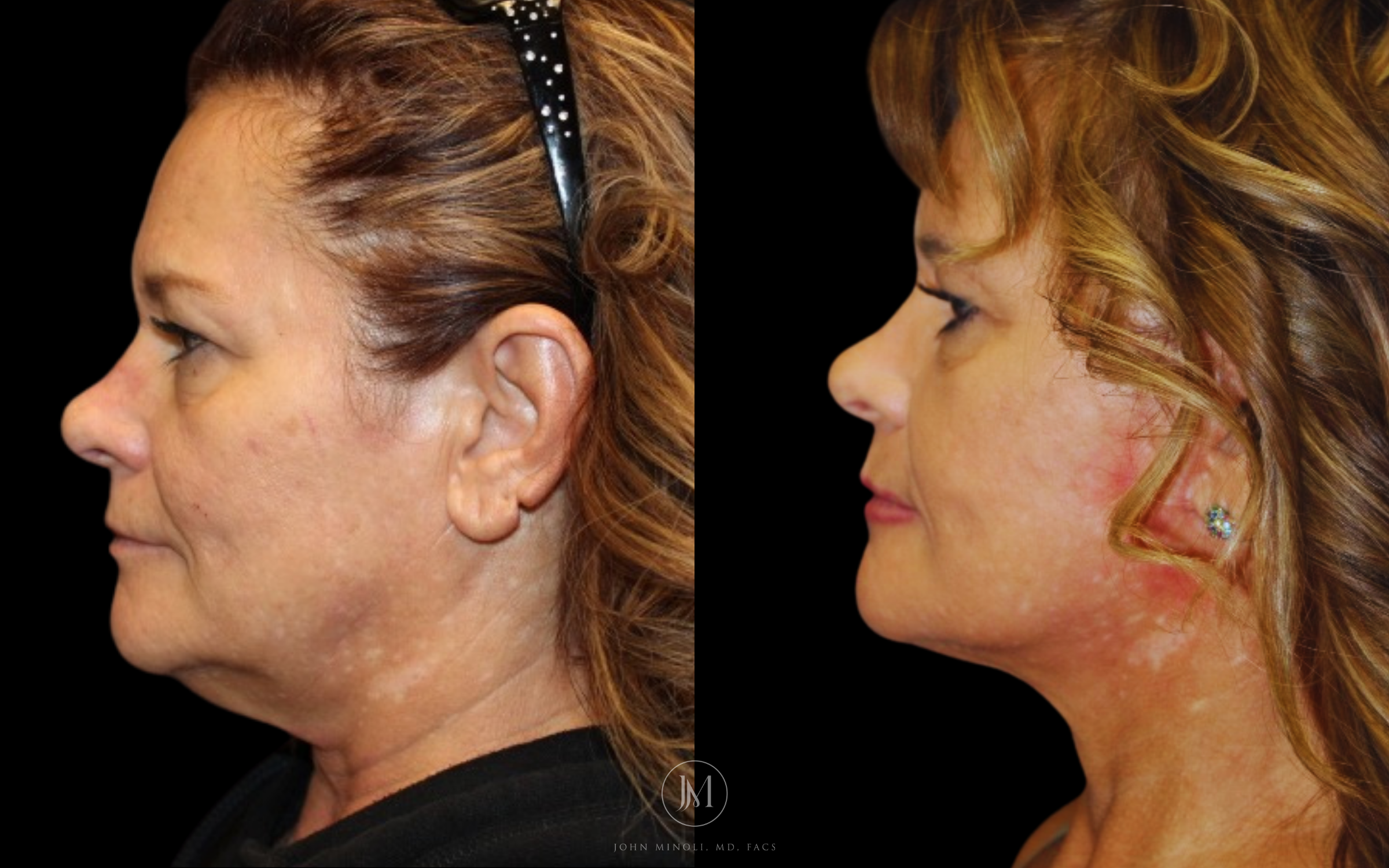 Face and Neck Lift Before and After