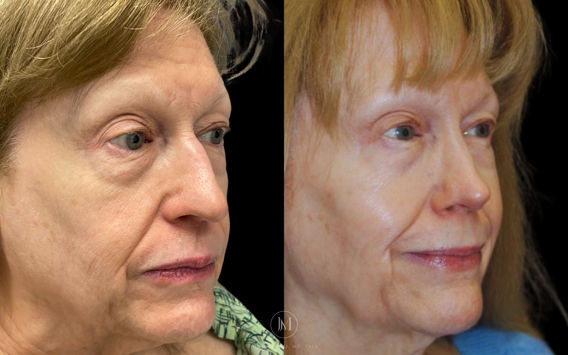 Primary Rhinoplasty before and after