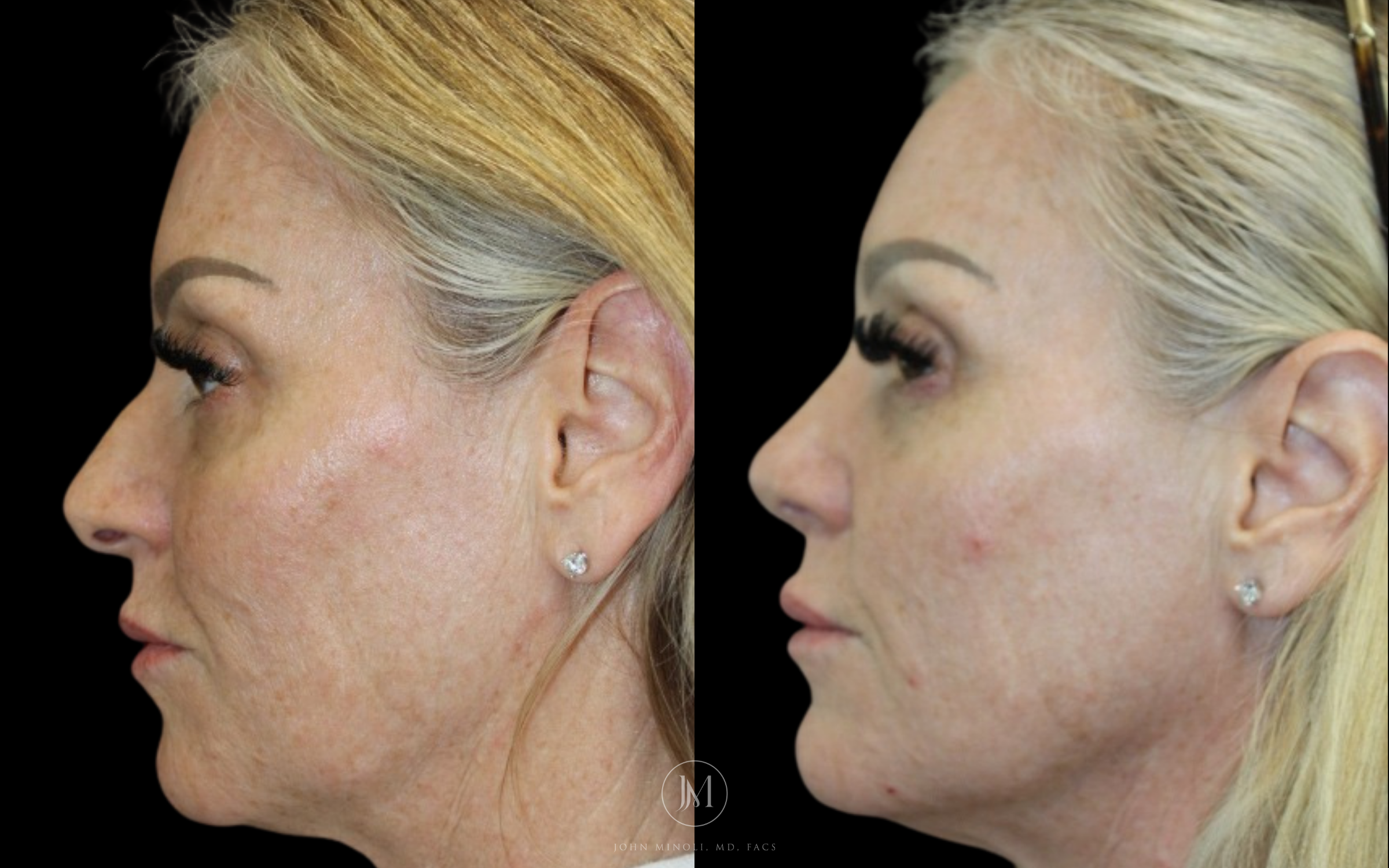 Primary Rhinoplasty Left Profile