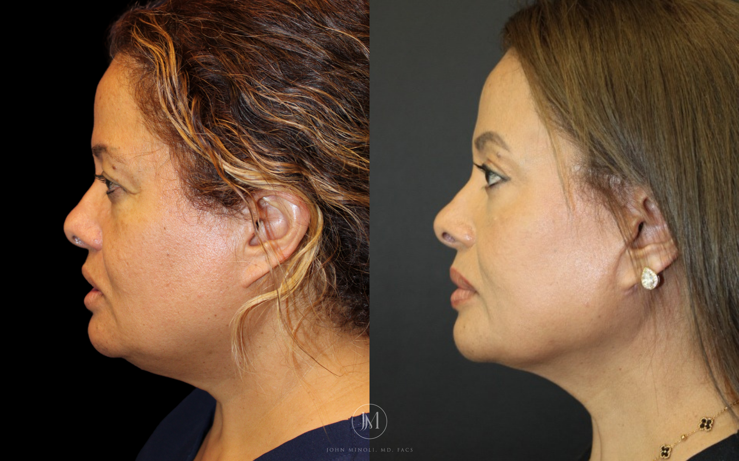 Face and Neck Lift Before and After