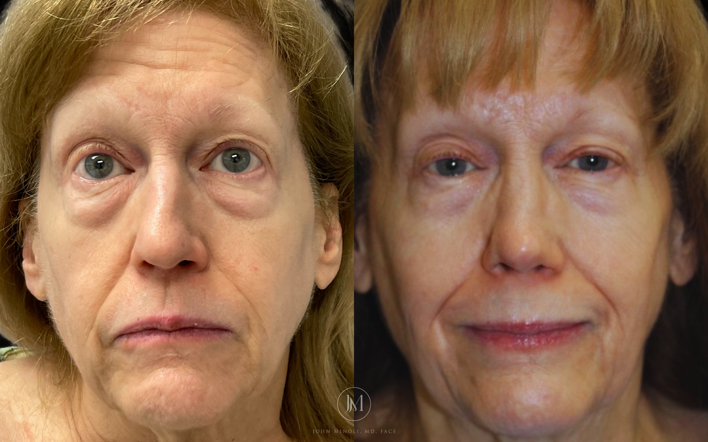 Primary Rhinoplasty before and after