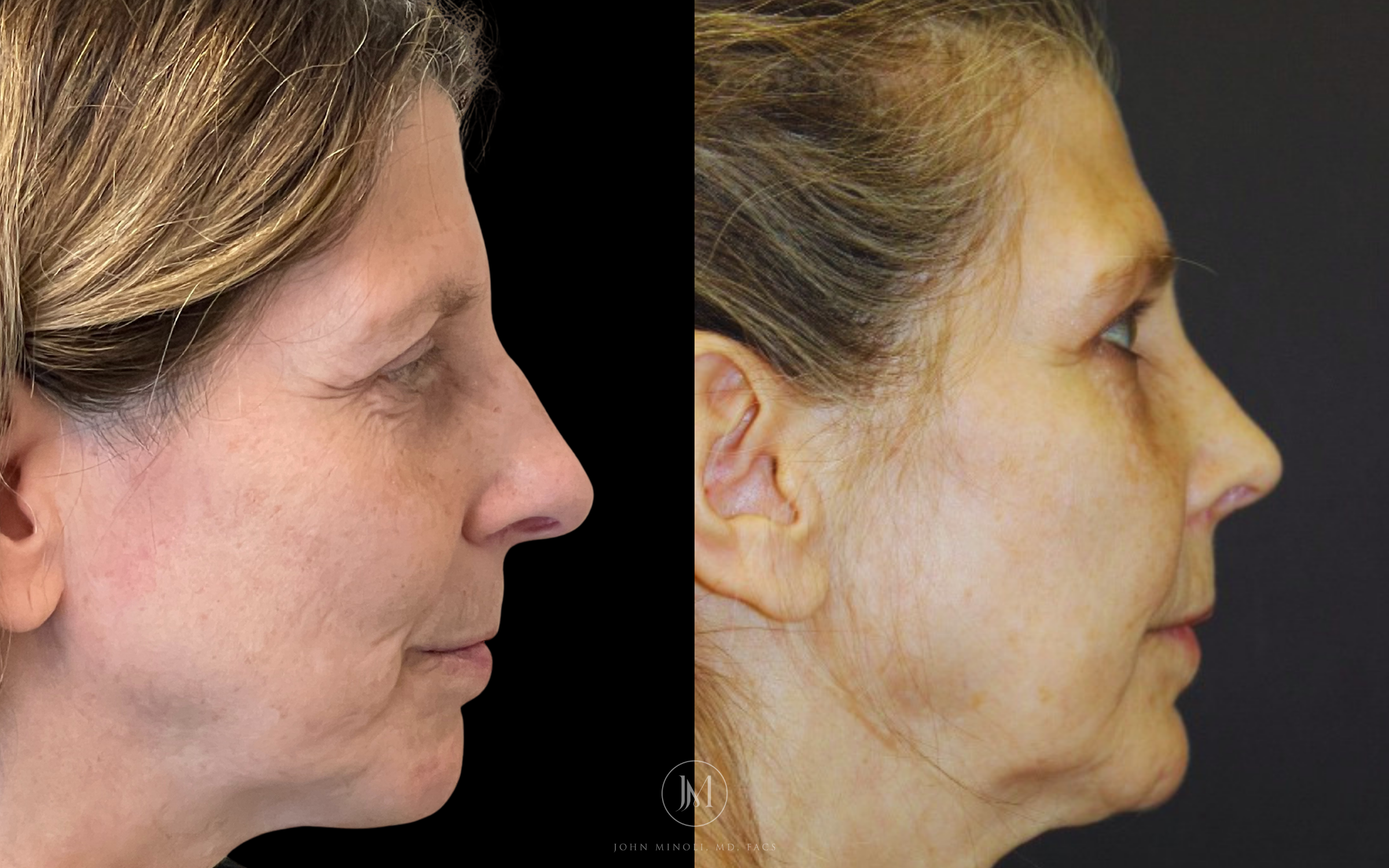 Primary Rhinoplasty before and after