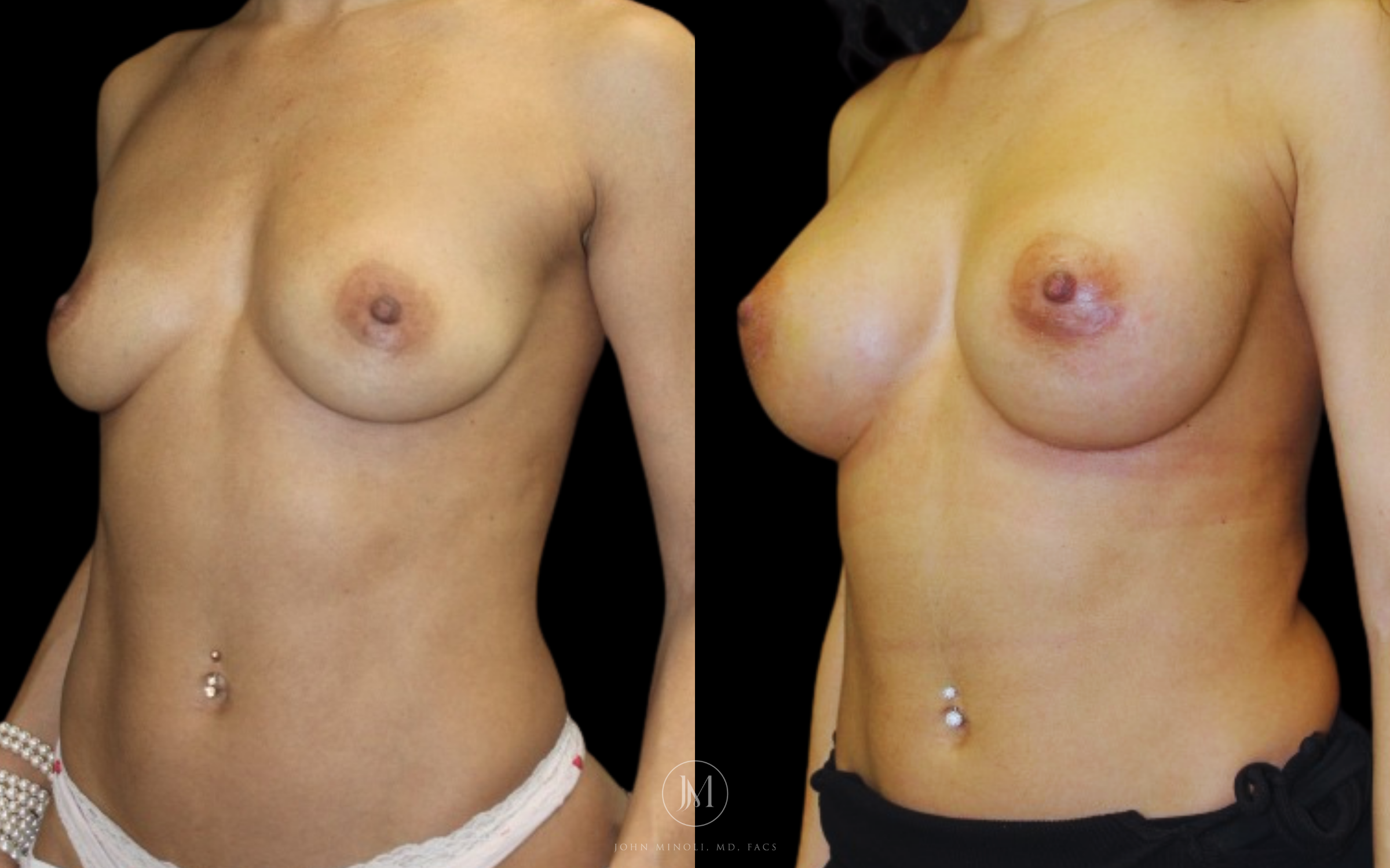 breast augmentation before and after