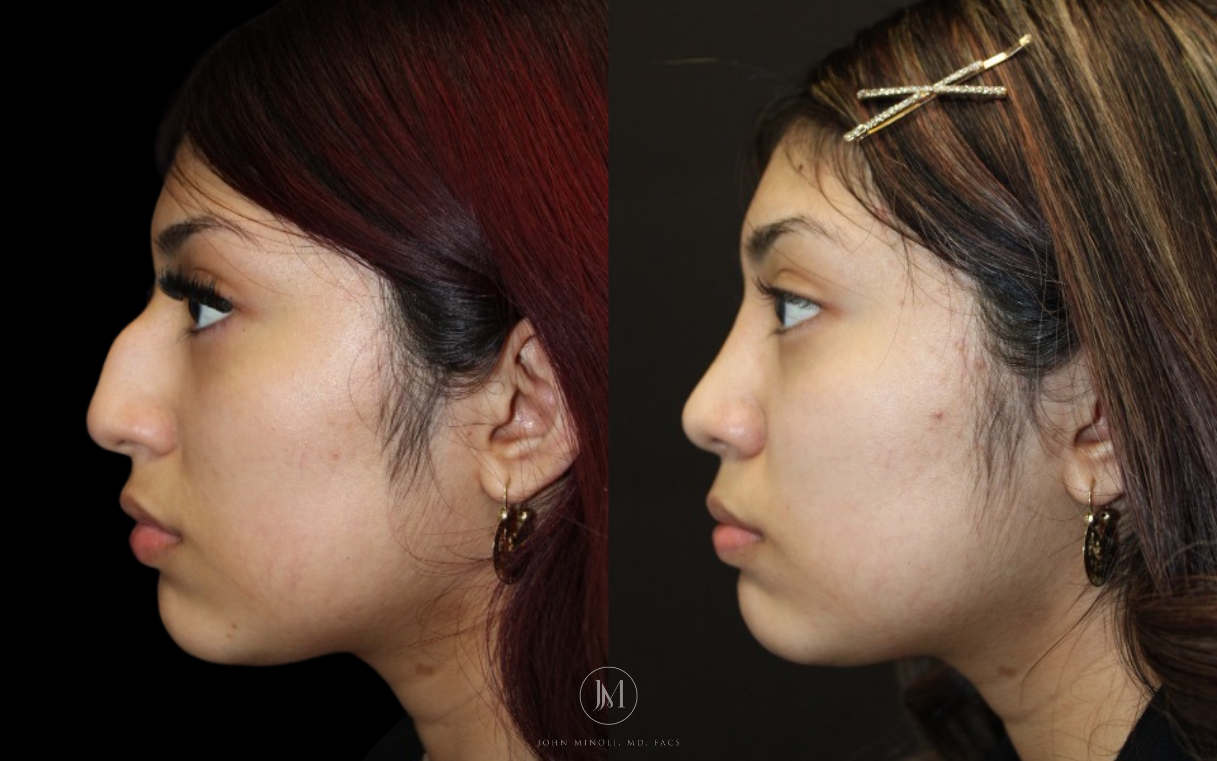 Before and After Primary Rhinoplasty