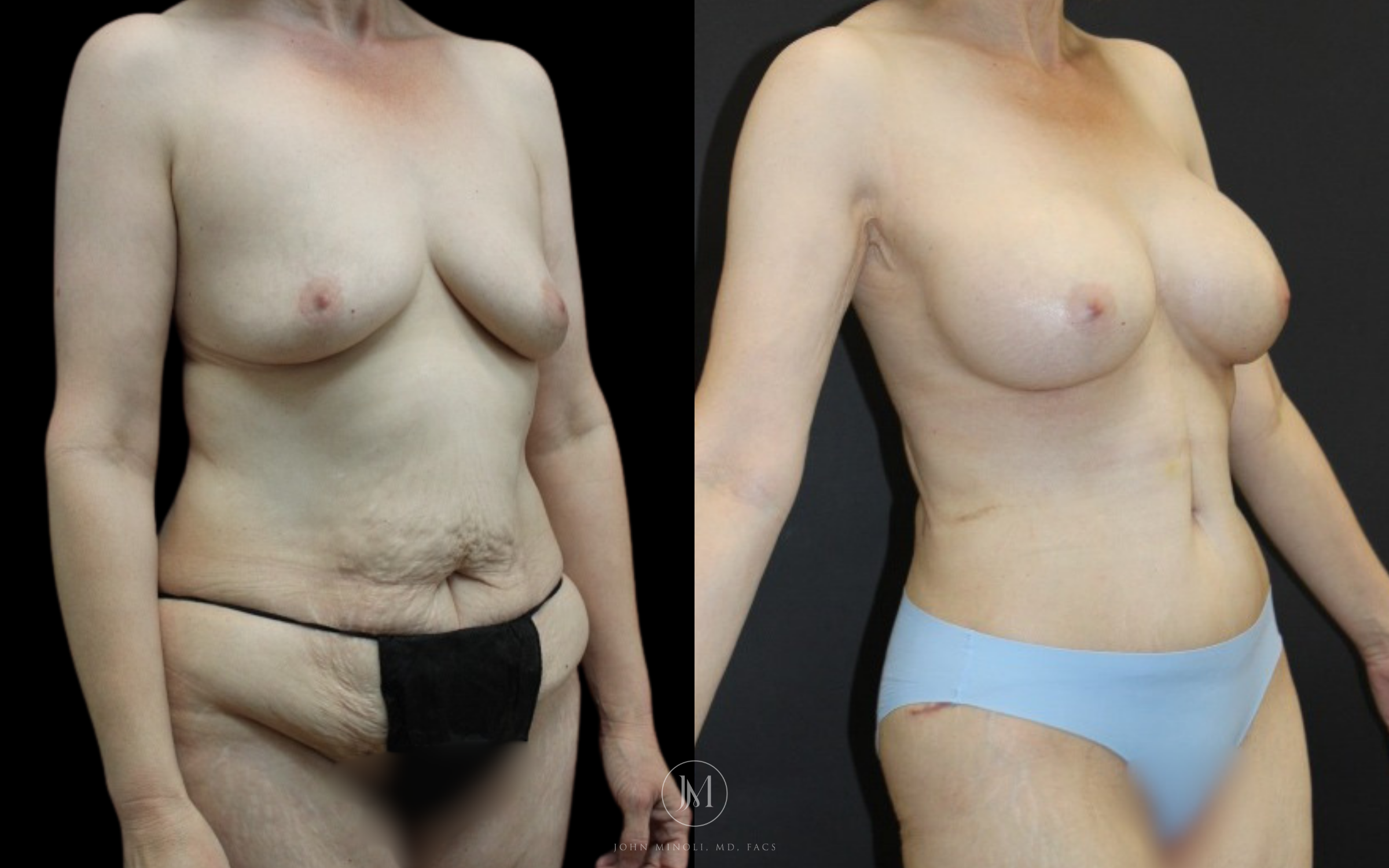 mommy make over45 degree before and after