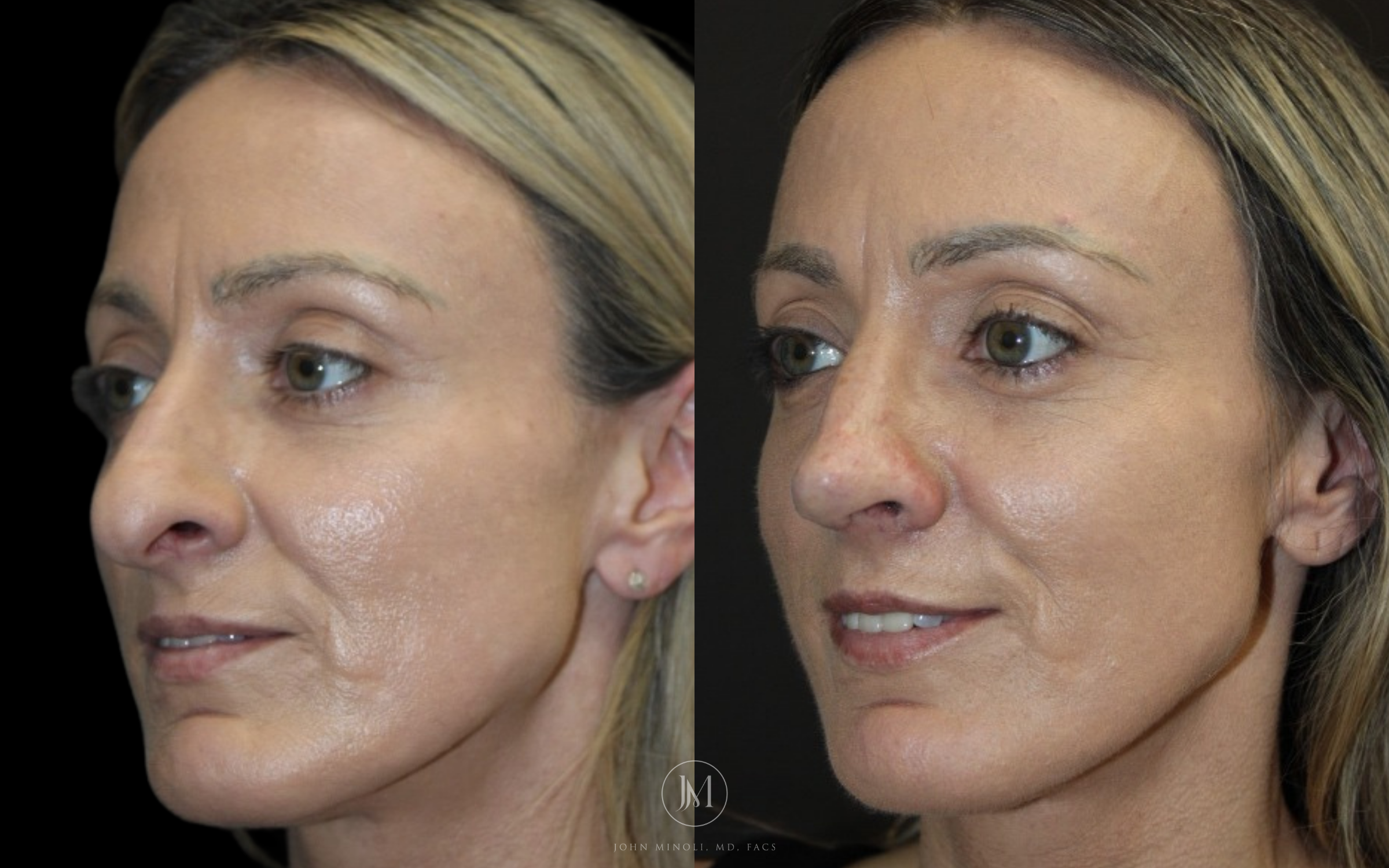 Primary Rhinoplasty before and after