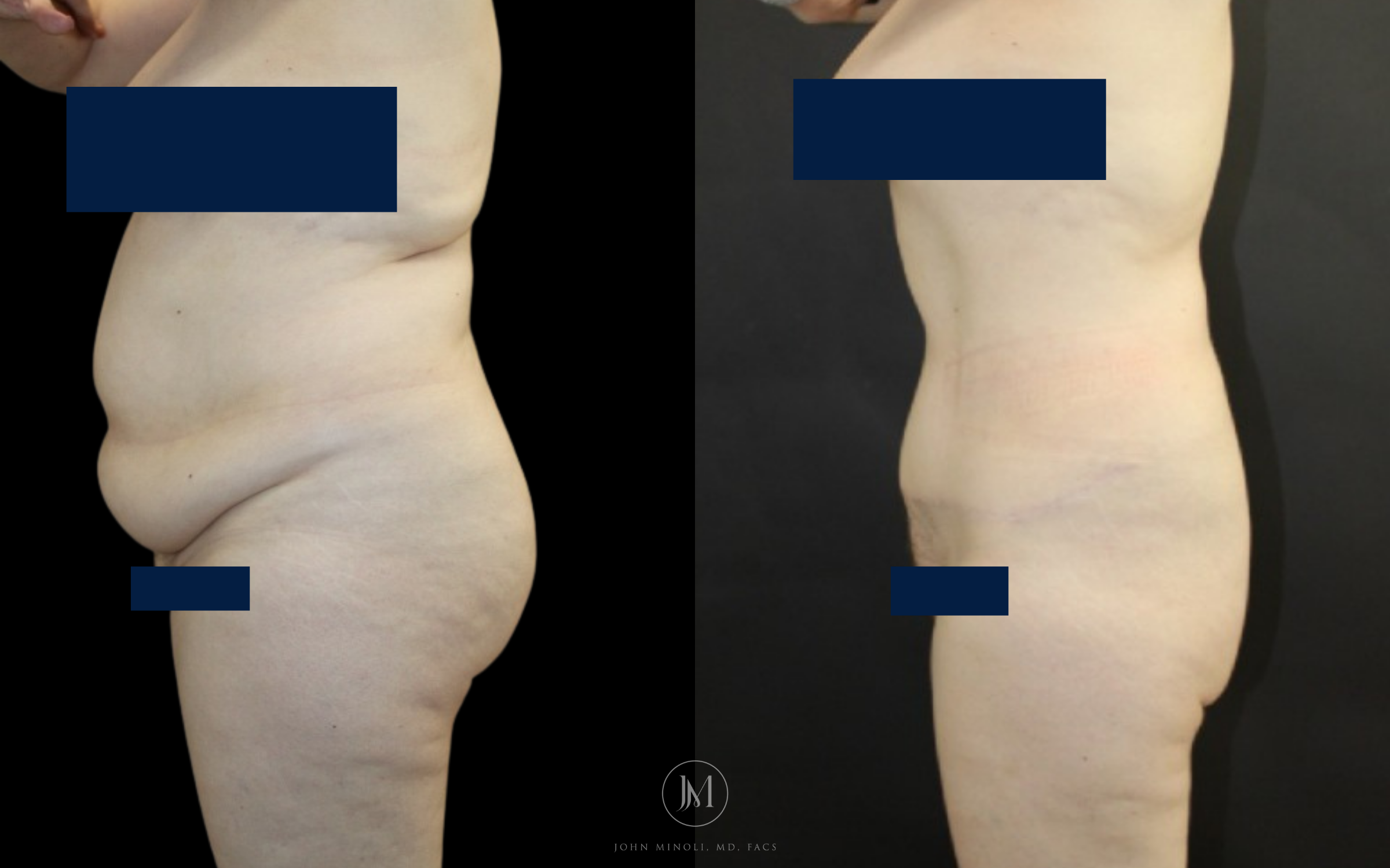 abdominoplasty before and after