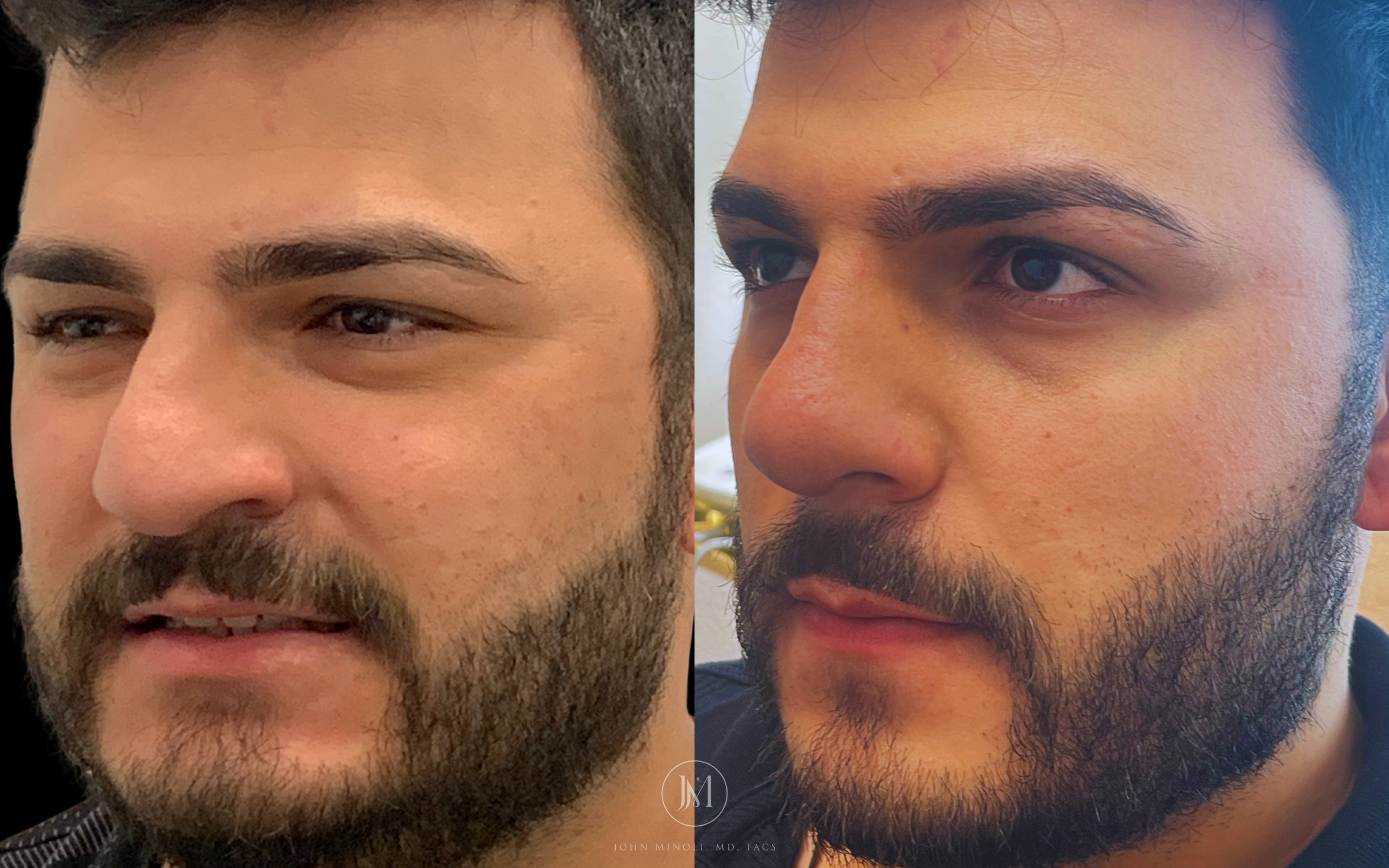 Primary Rhinoplasty before and after