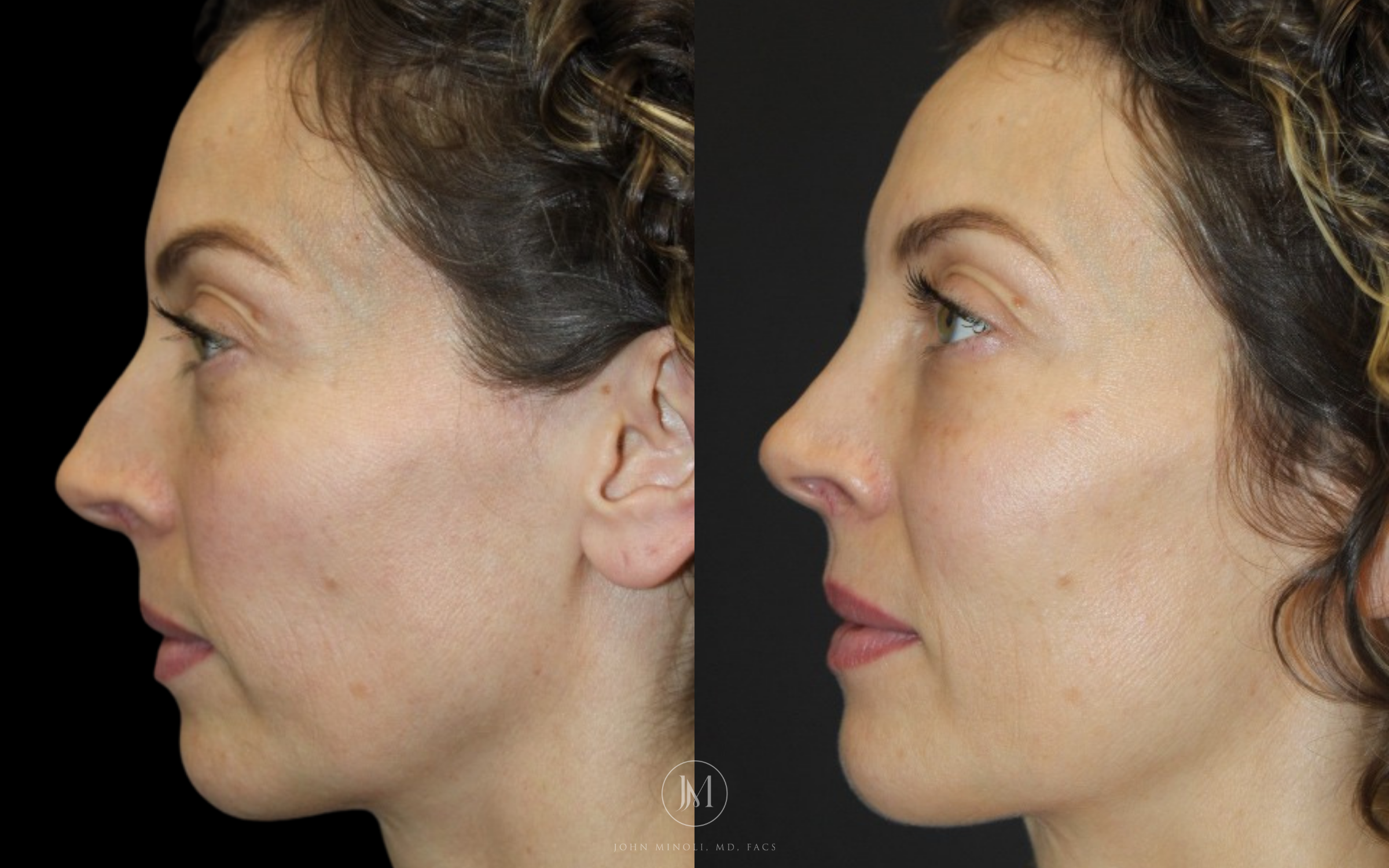 Primary Rhinoplasty before and after