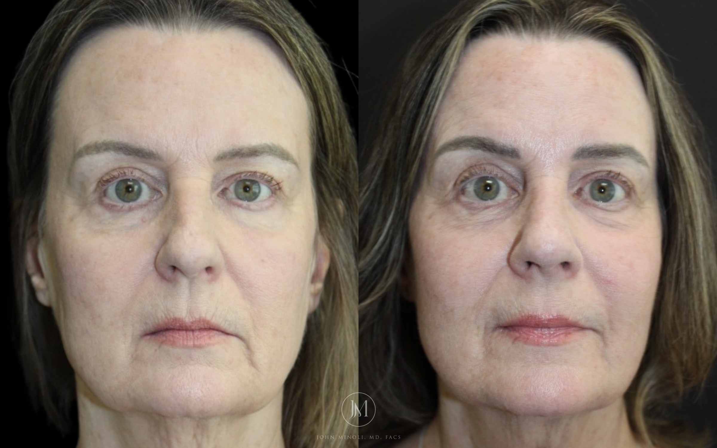 Primary Rhinoplasty before and after