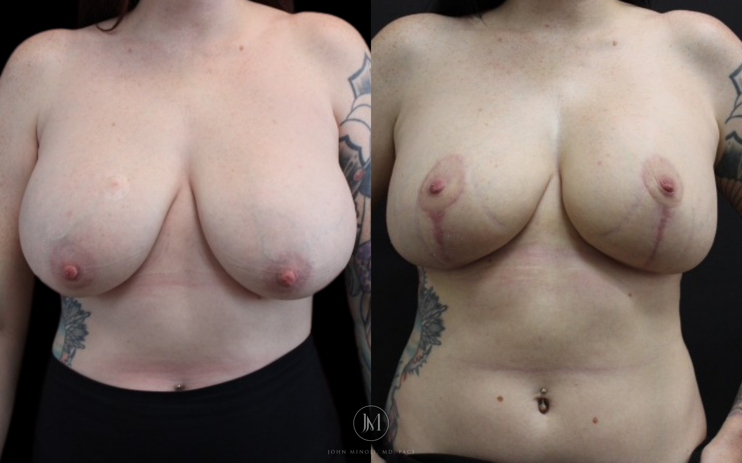 WOMAN BREAST RECONSTRUCTION  B&A