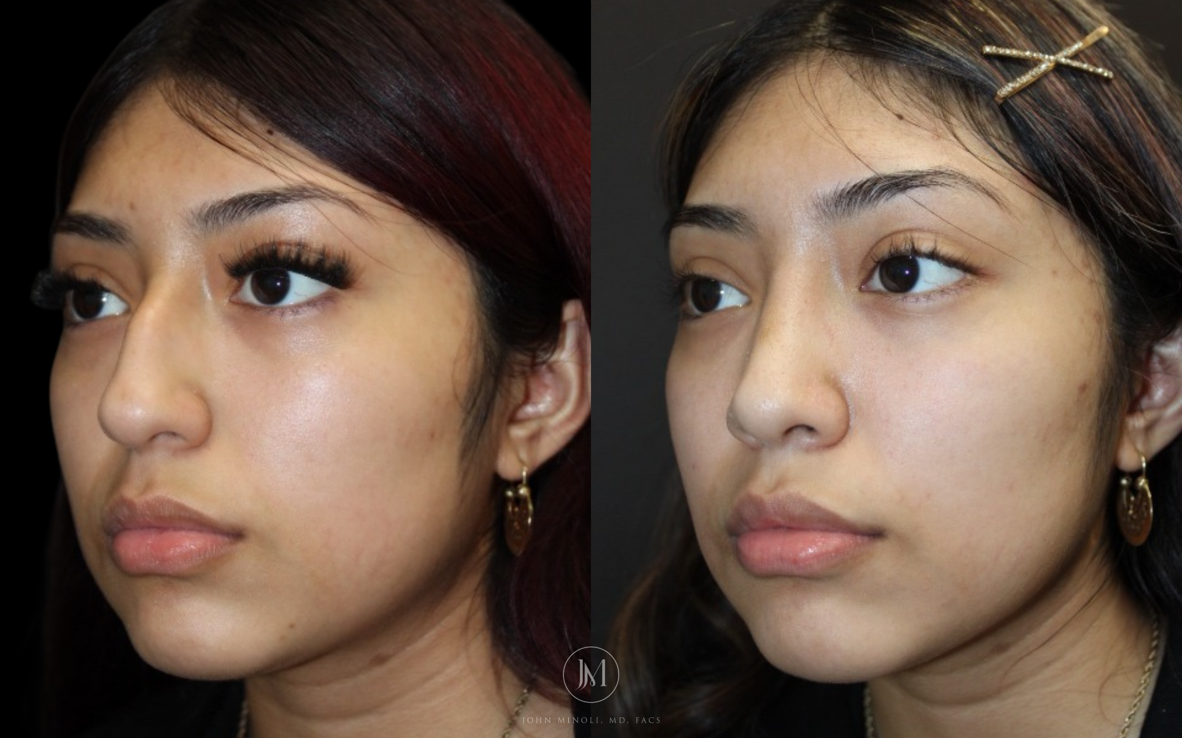 Before and After Primary Rhinoplasty