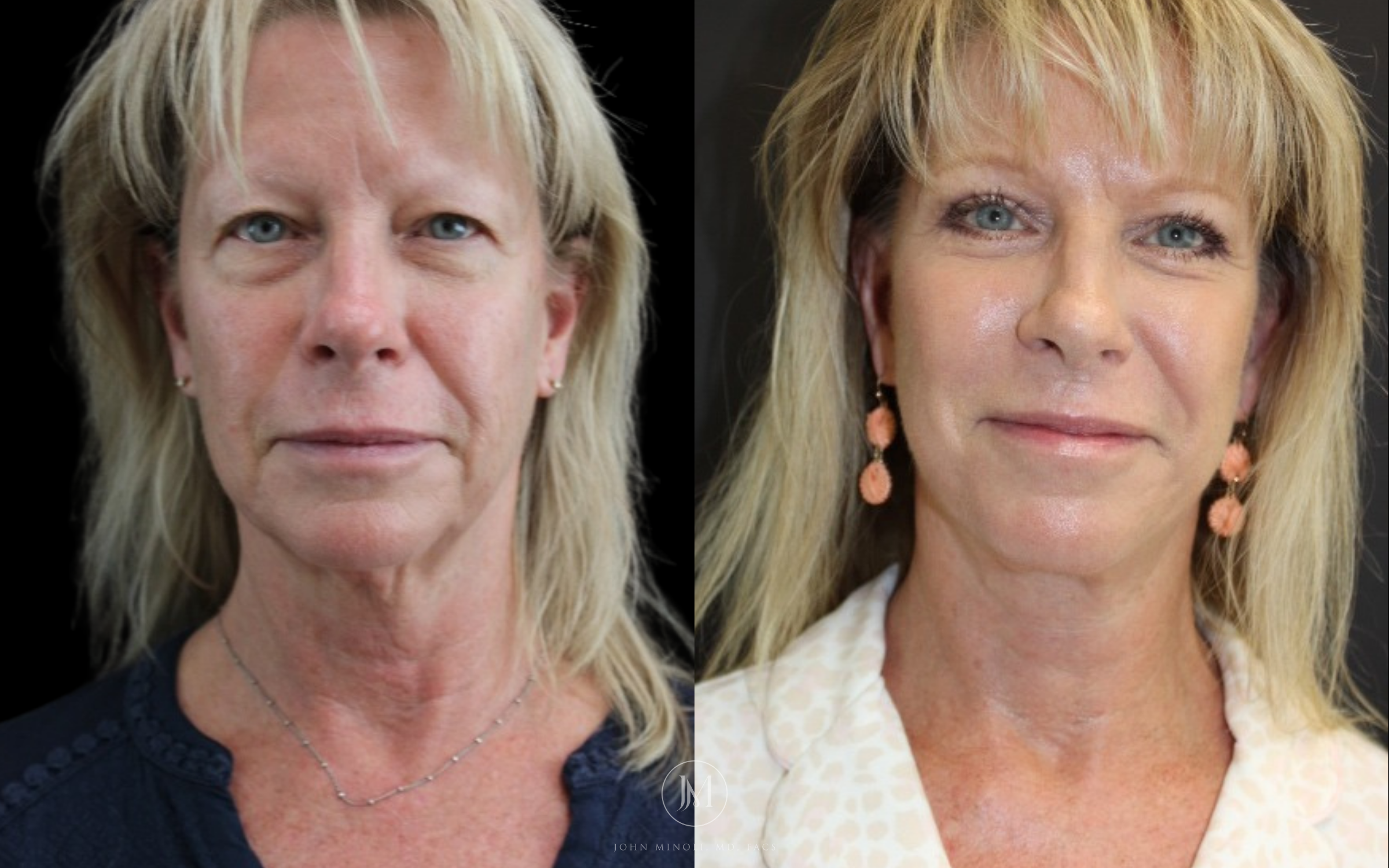 Face and Neck Lift Before and After