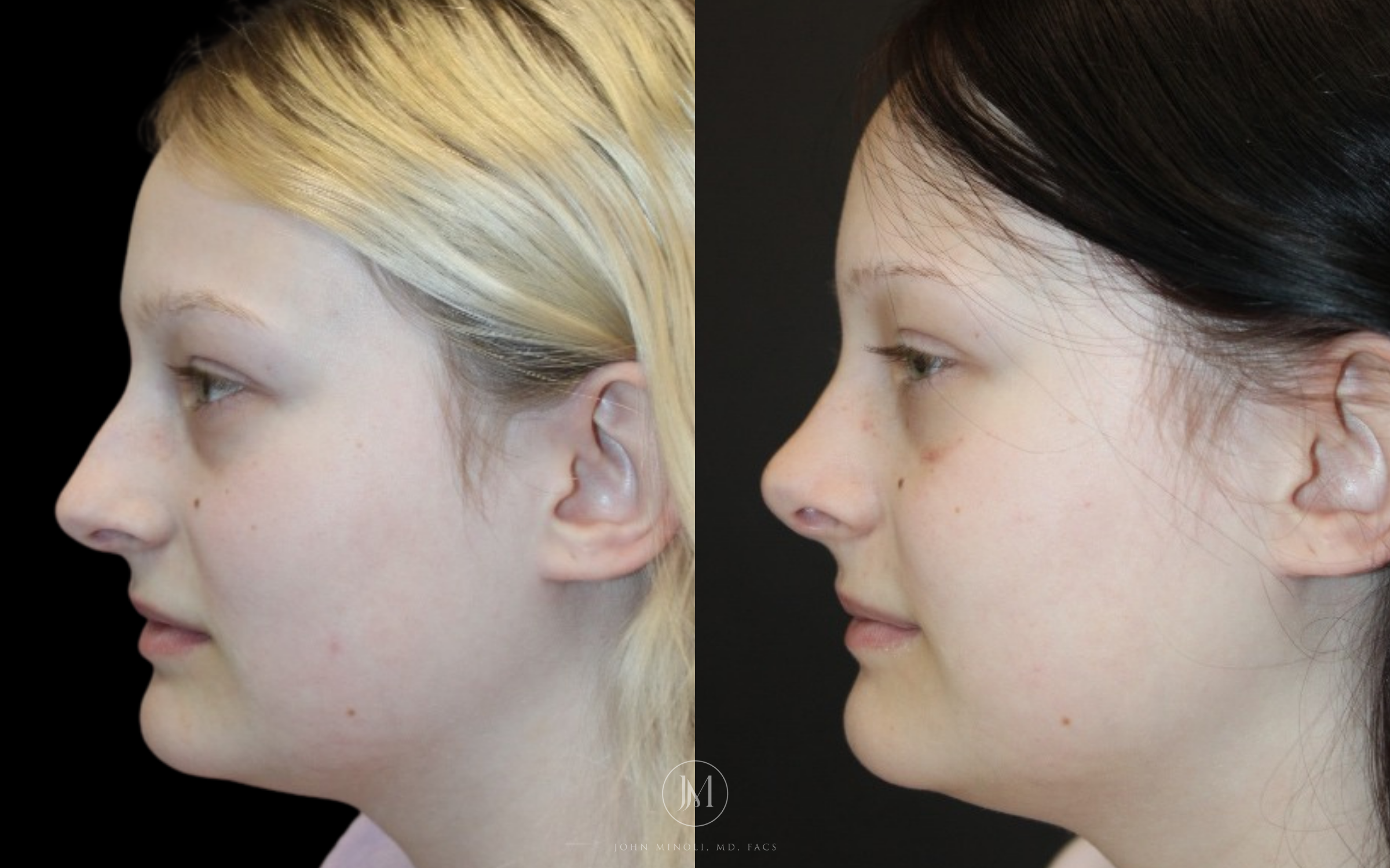 Primary Rhinoplasty before and after