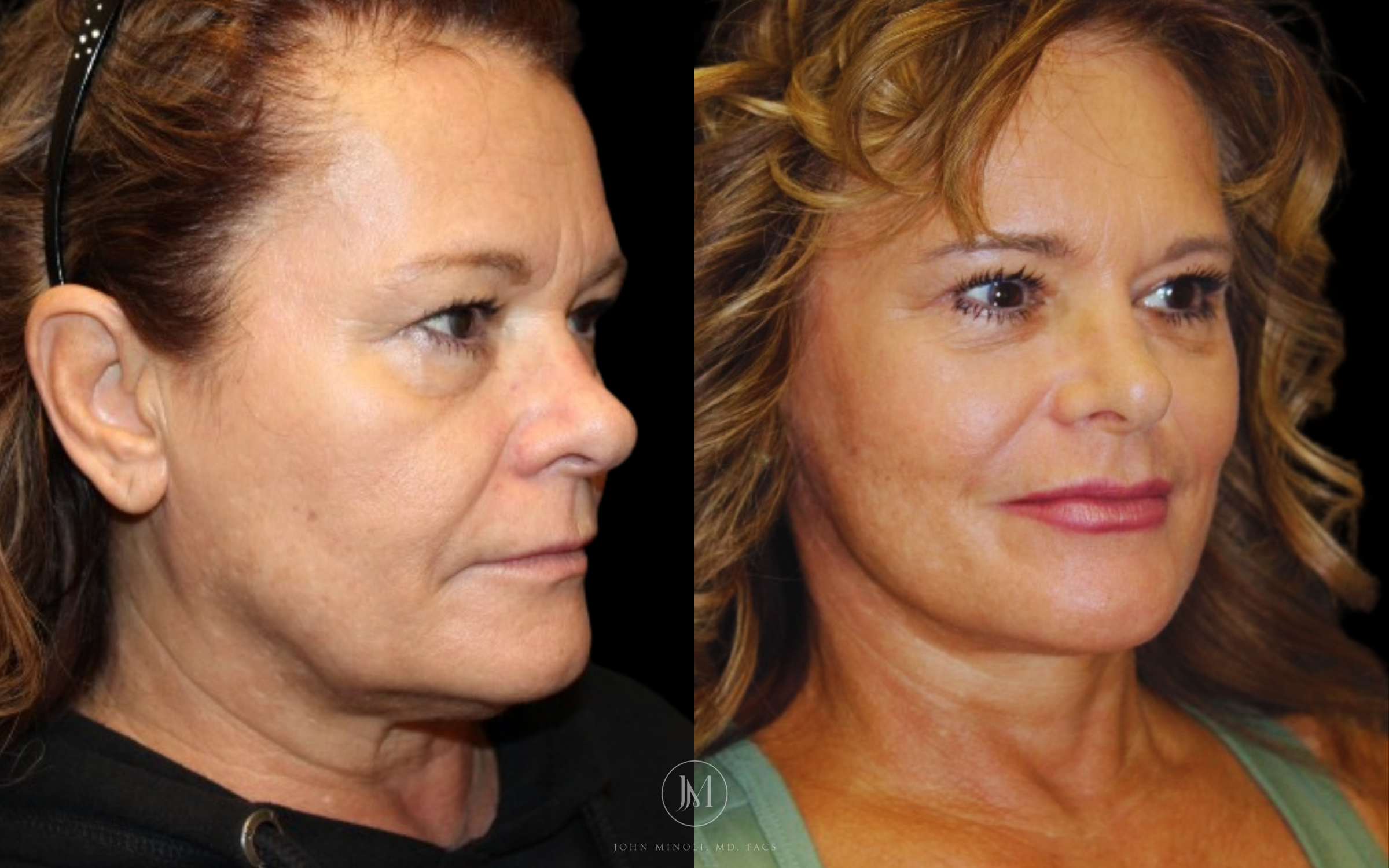 Face and Neck Lift Before and After