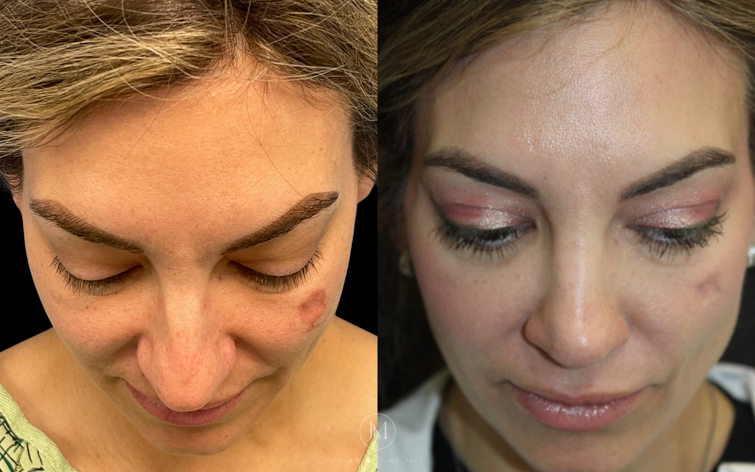 Woman Before and After rhinoplasty
