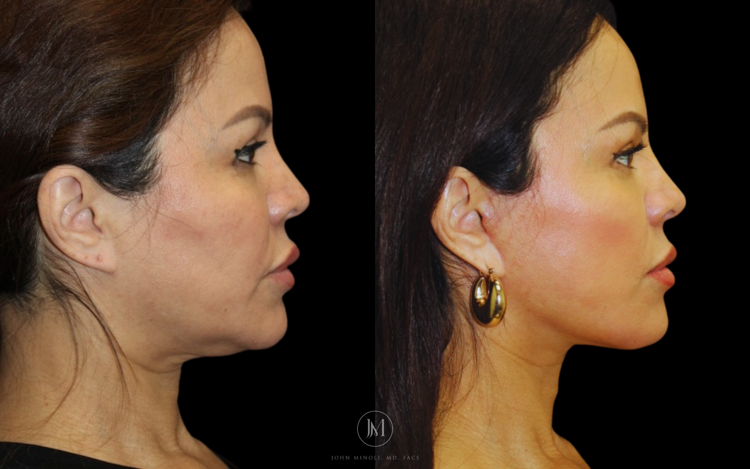 Neck Lift Before and After