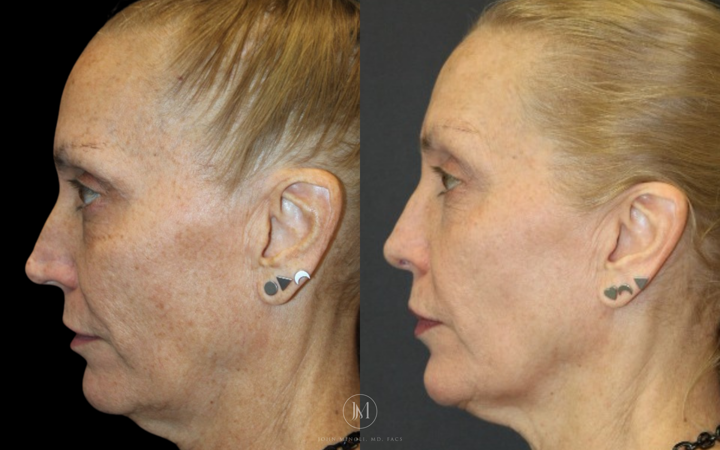 Revision Rhinoplasty Before and After