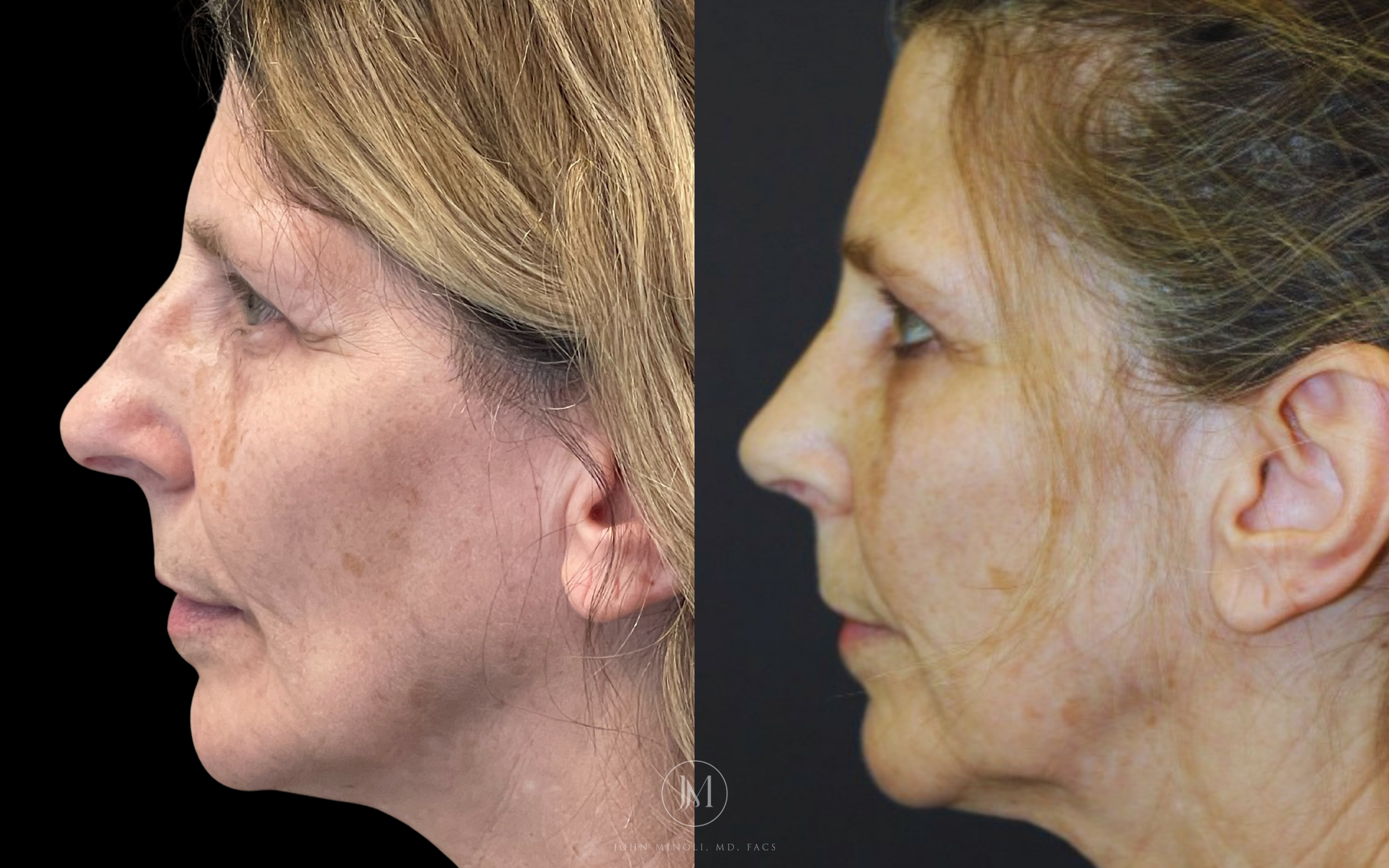 Primary Rhinoplasty before and after