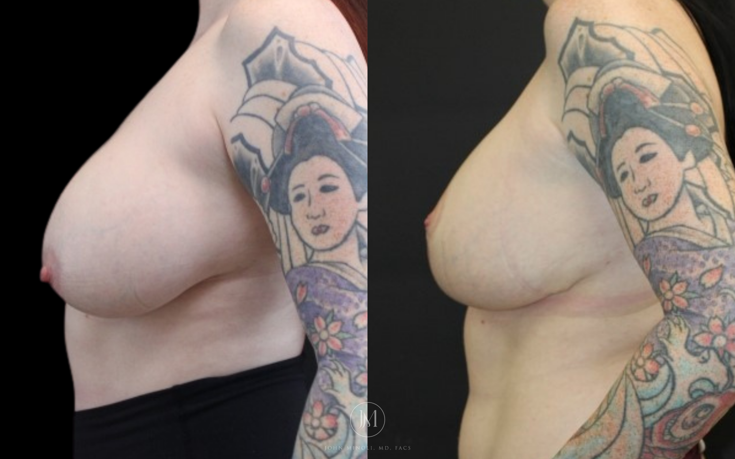 WOMAN BREAST RECONSTRUCTION  B&A