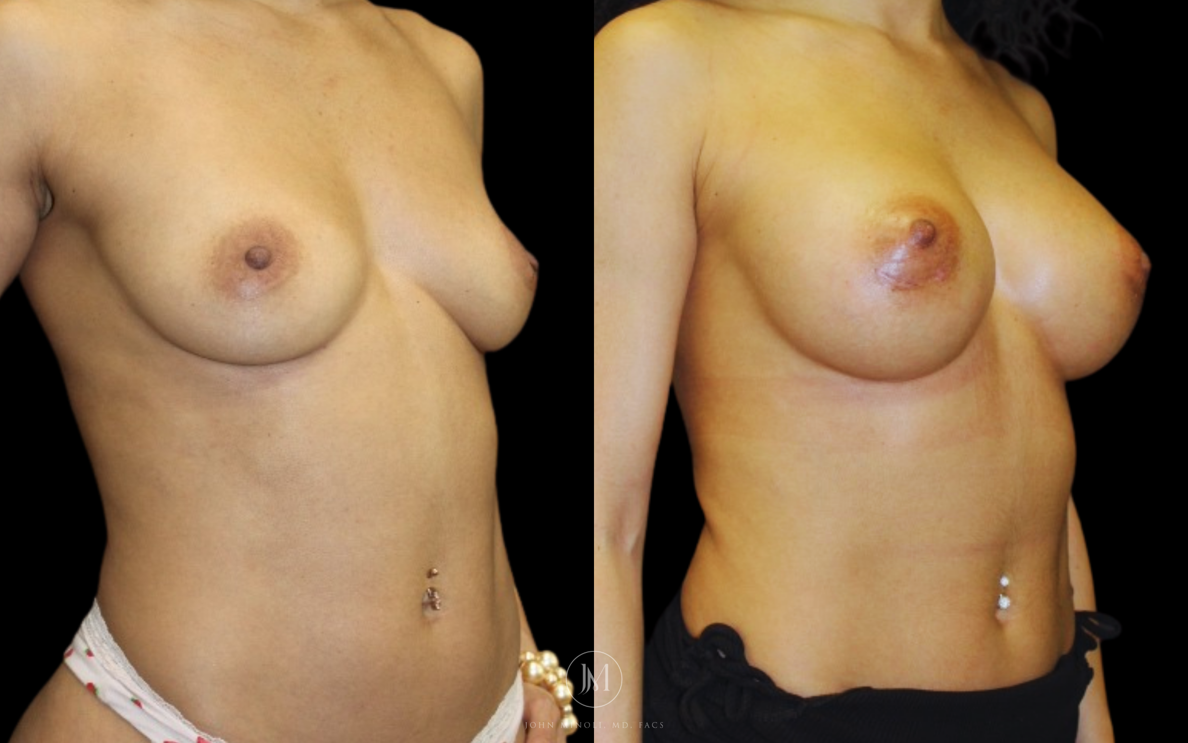 breast augmentation before and after